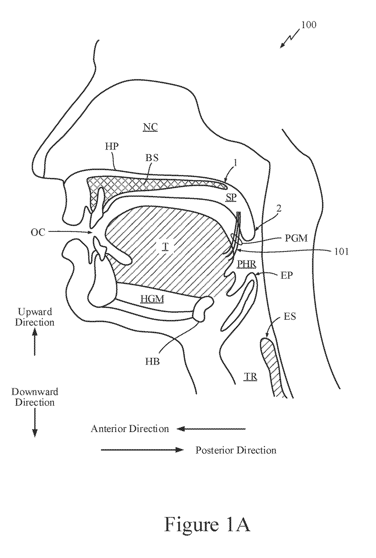 Method and apparatus for treating sleep apnea