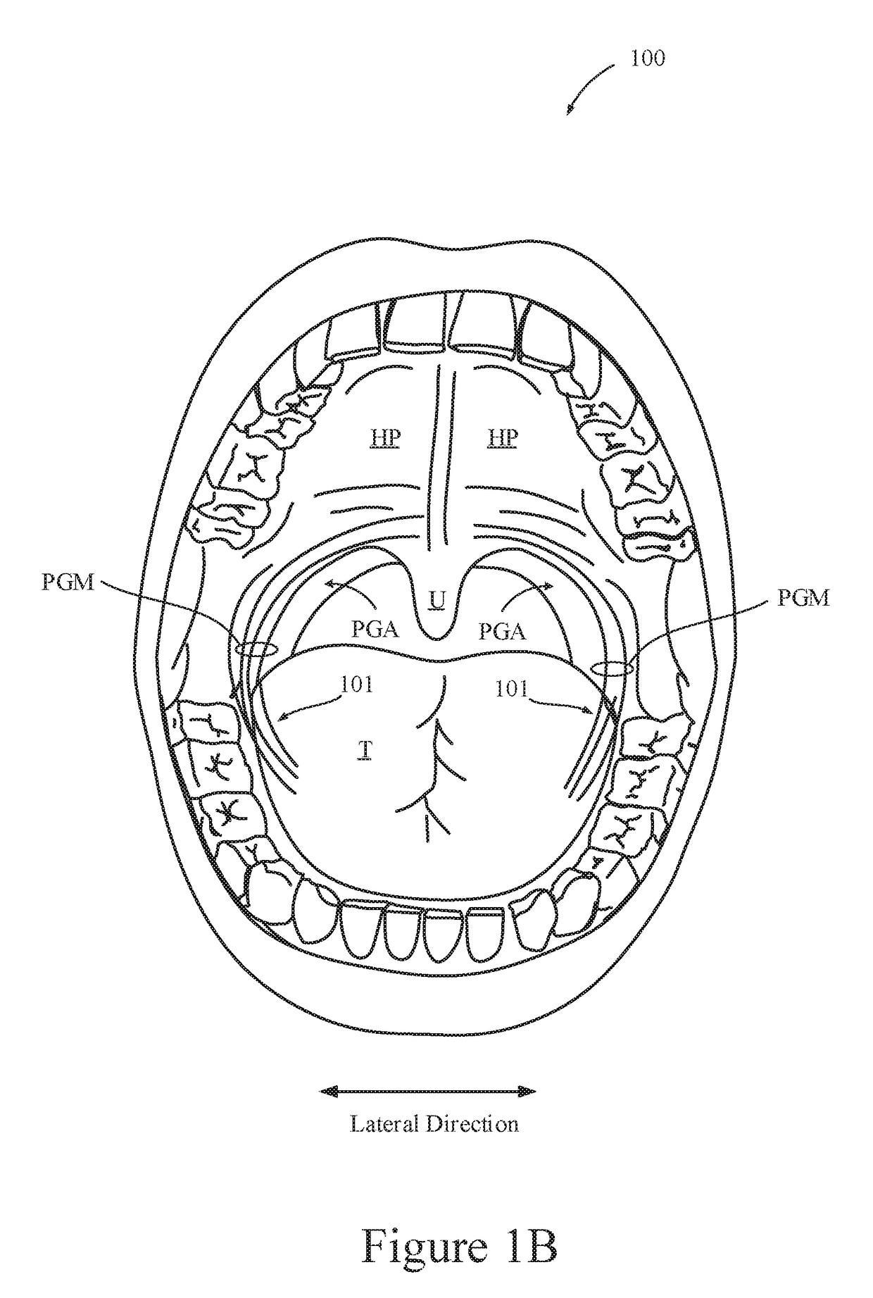 Method and apparatus for treating sleep apnea