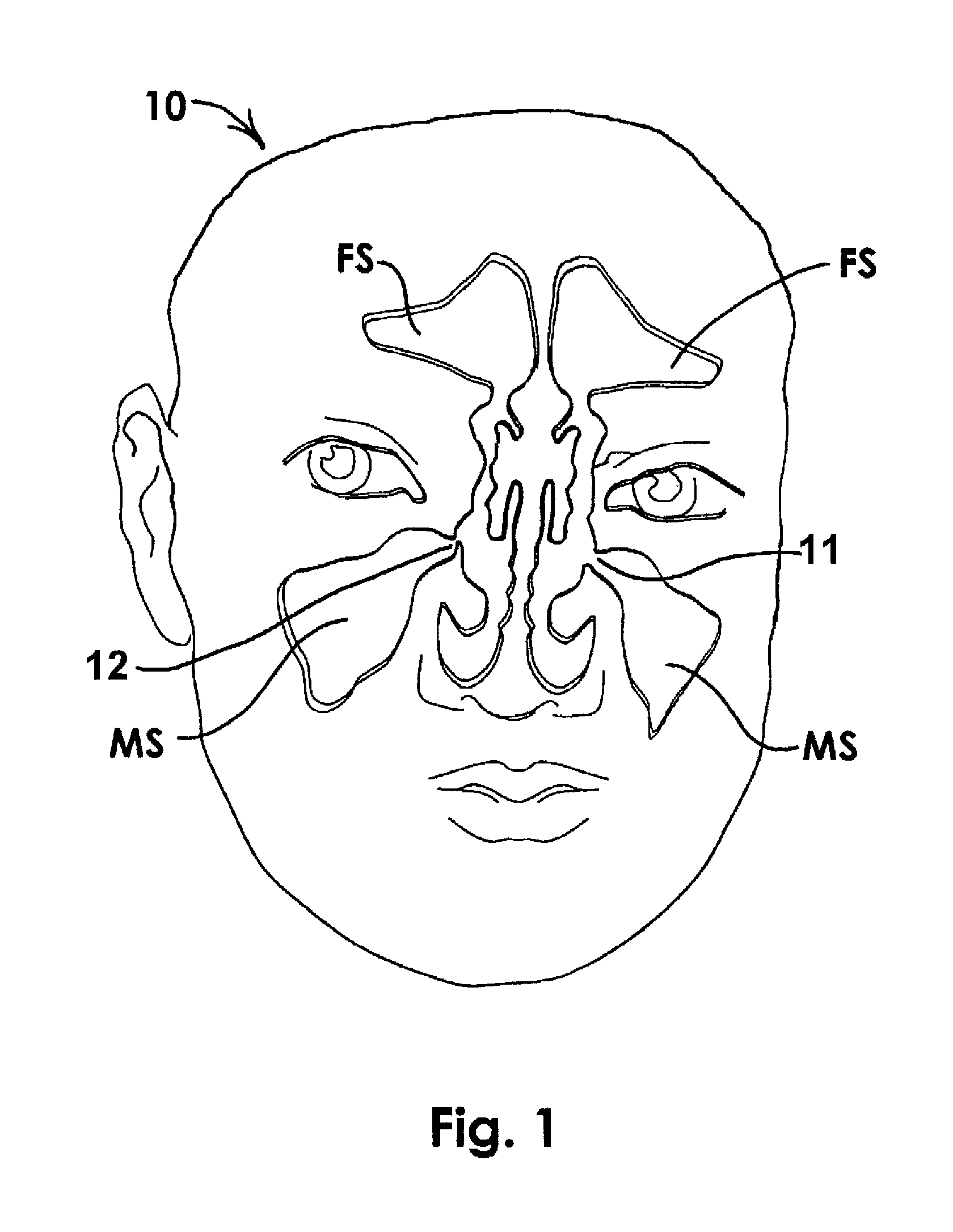 Devices and Methods for Dilating a Paranasal Sinus Opening and for Treating Sinusitis