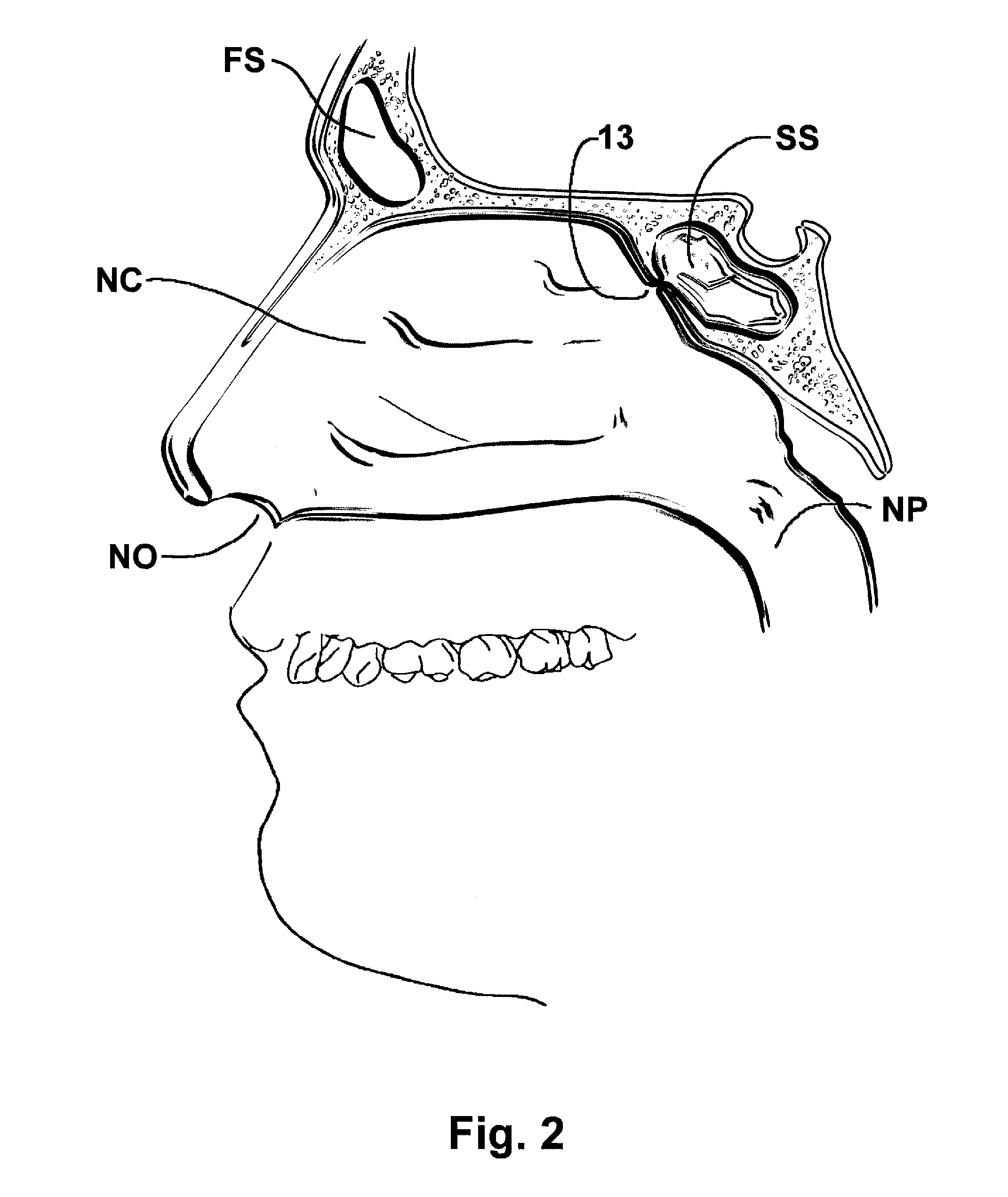 Devices and Methods for Dilating a Paranasal Sinus Opening and for Treating Sinusitis