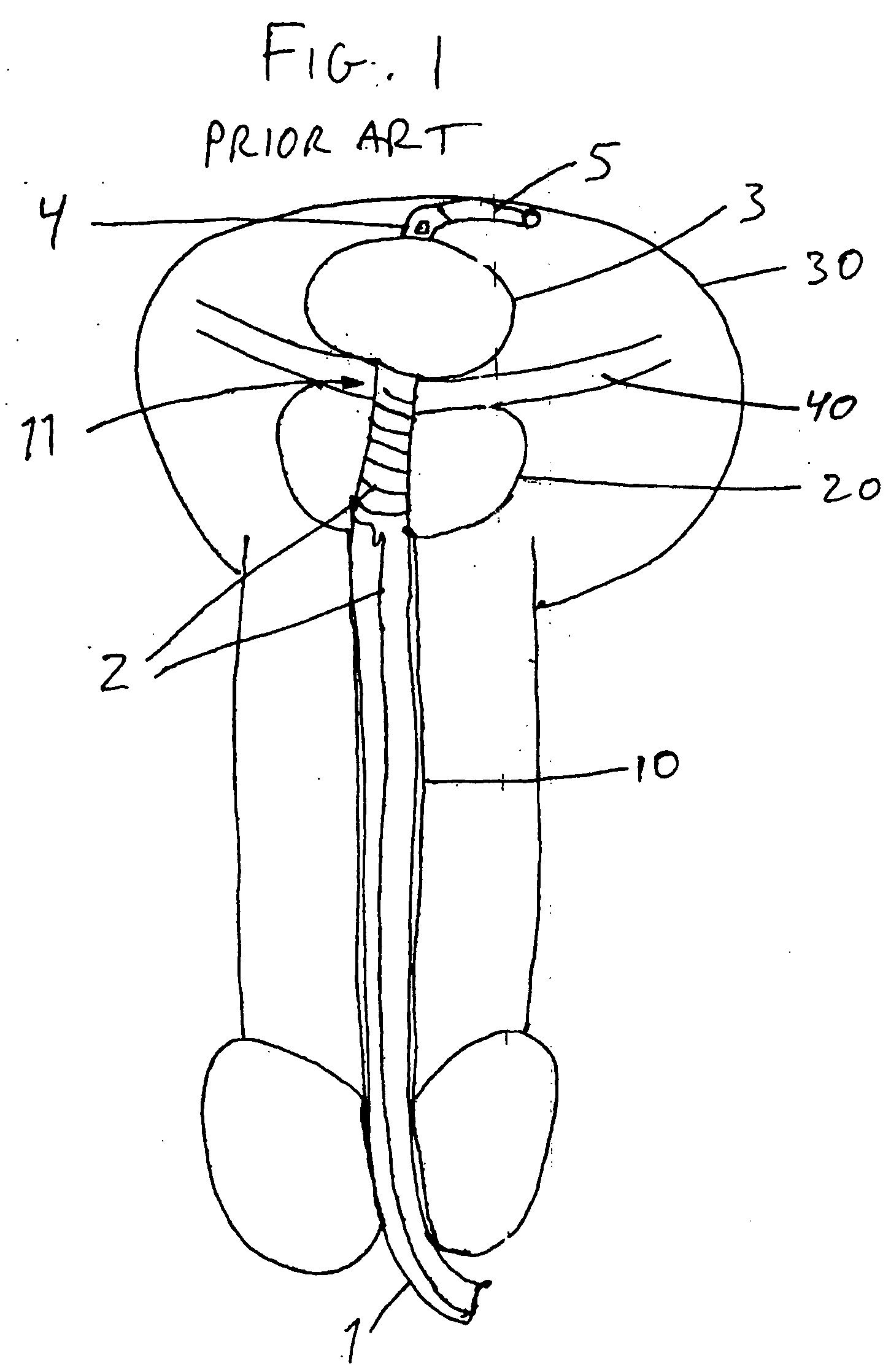 Illuminating balloon catheter and method for using the catheter