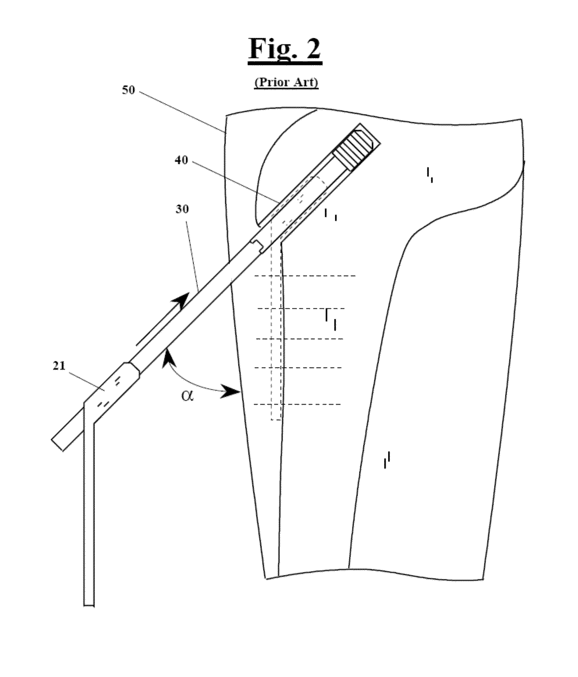 Device for facilitating the application of a fixing plate to the relative screw for the minimally invasive stabilization of pertrochanteric femoral fractures with sliding screw-plate systems