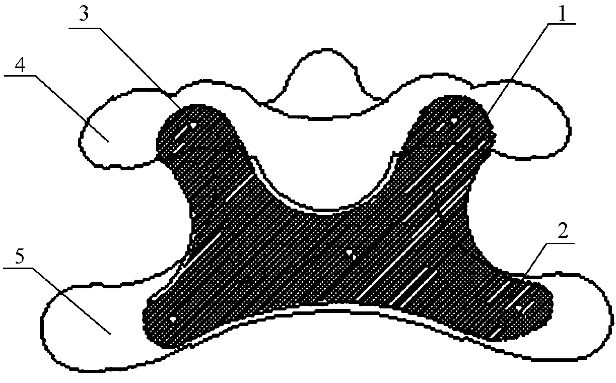 Anterior atlantoaxial fixing plate and making method