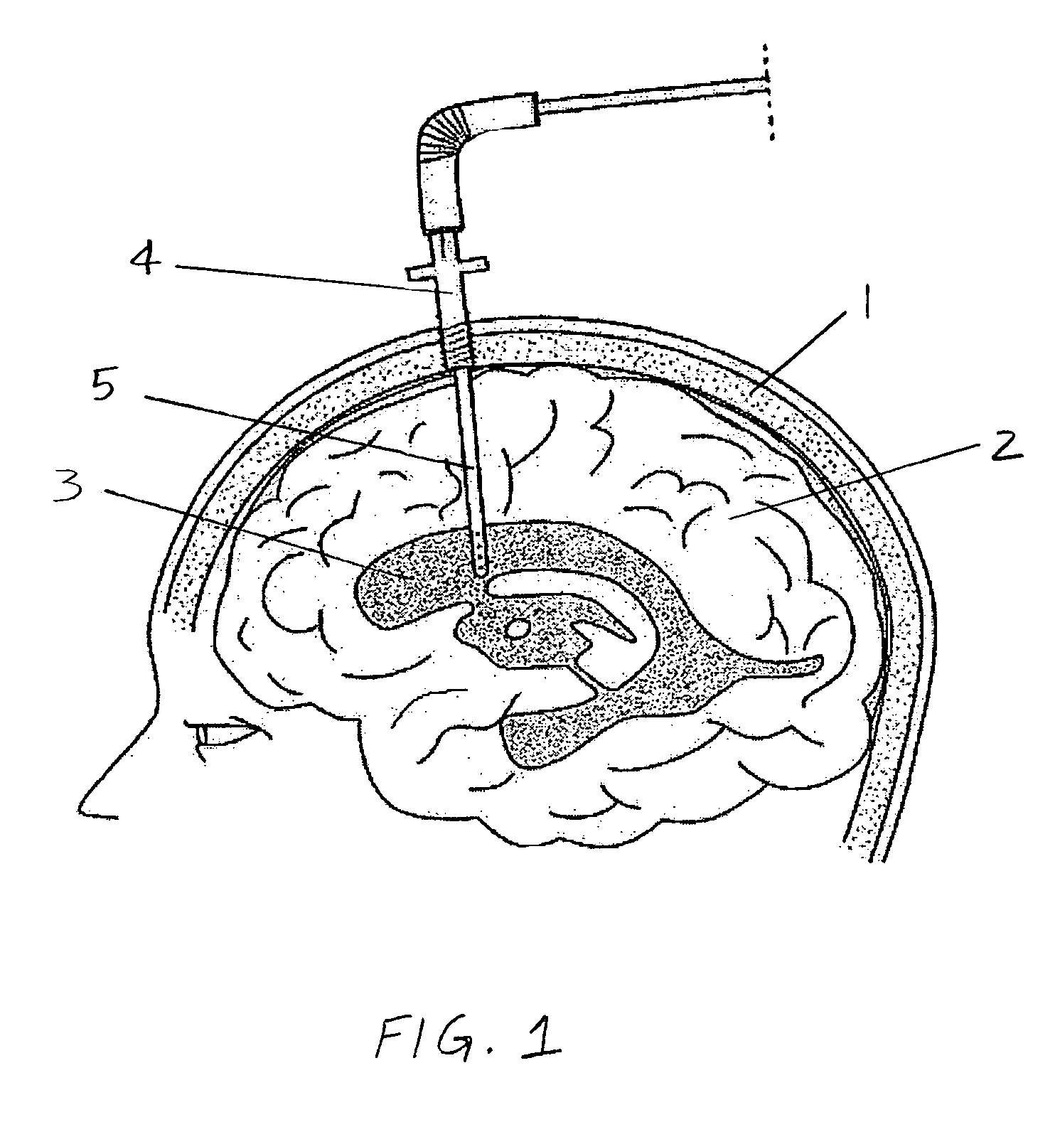 Central nervous system cooling catheter