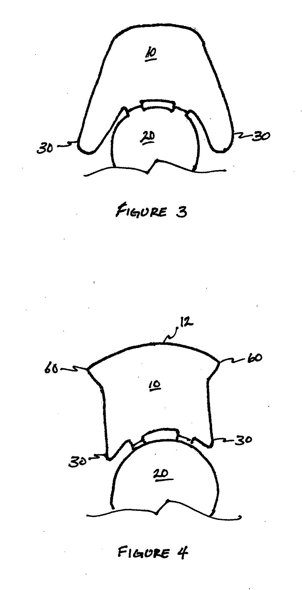 Vitreous Compressing Plate Haptic