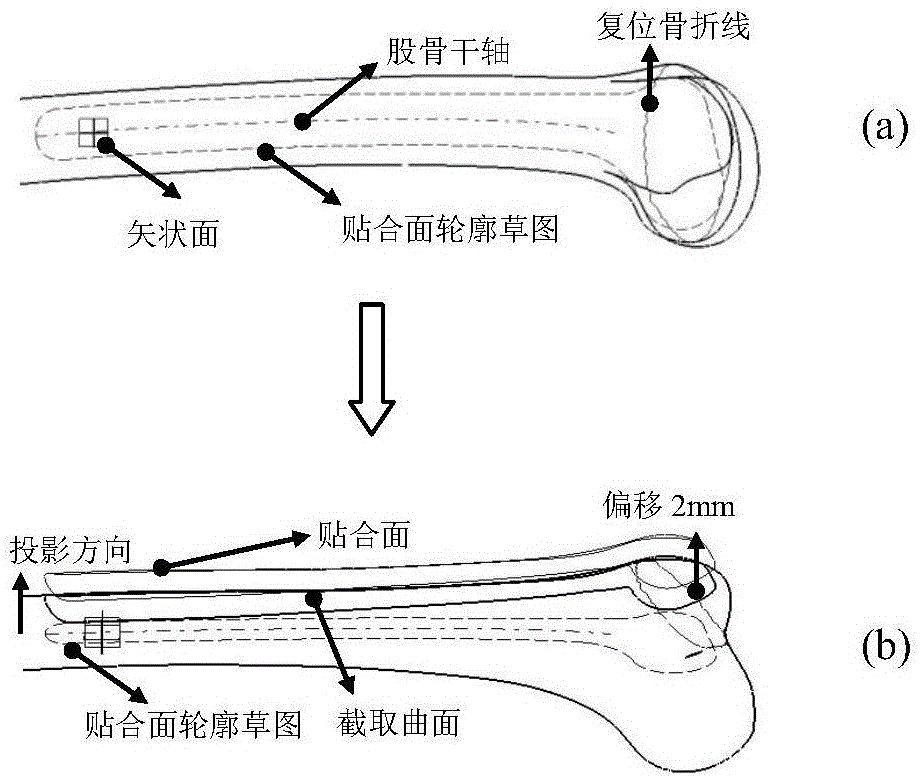 Customized far-end dissect type bone plate design method based on patient femur parameter