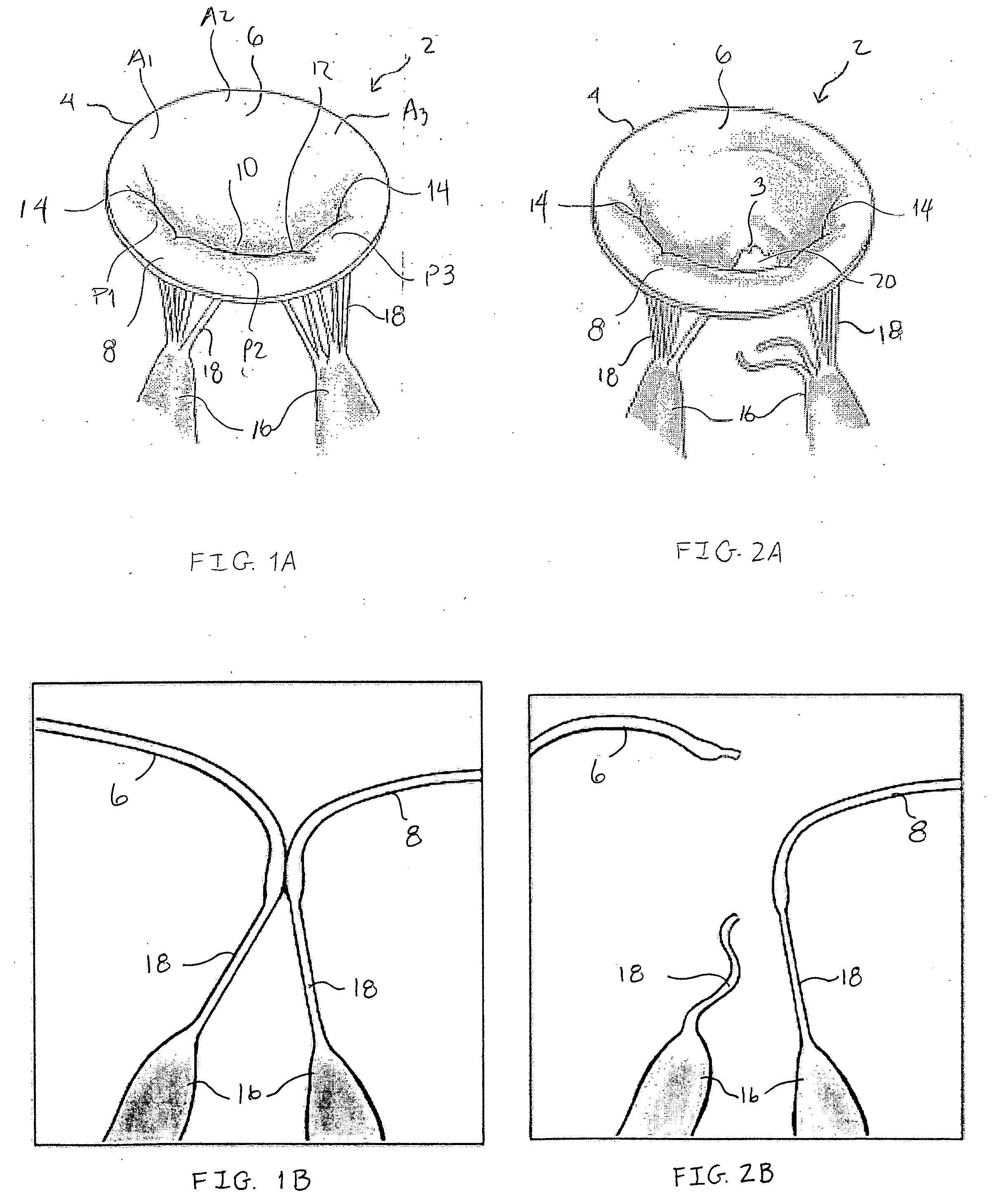 Devices and methods for repairing cardiac valves