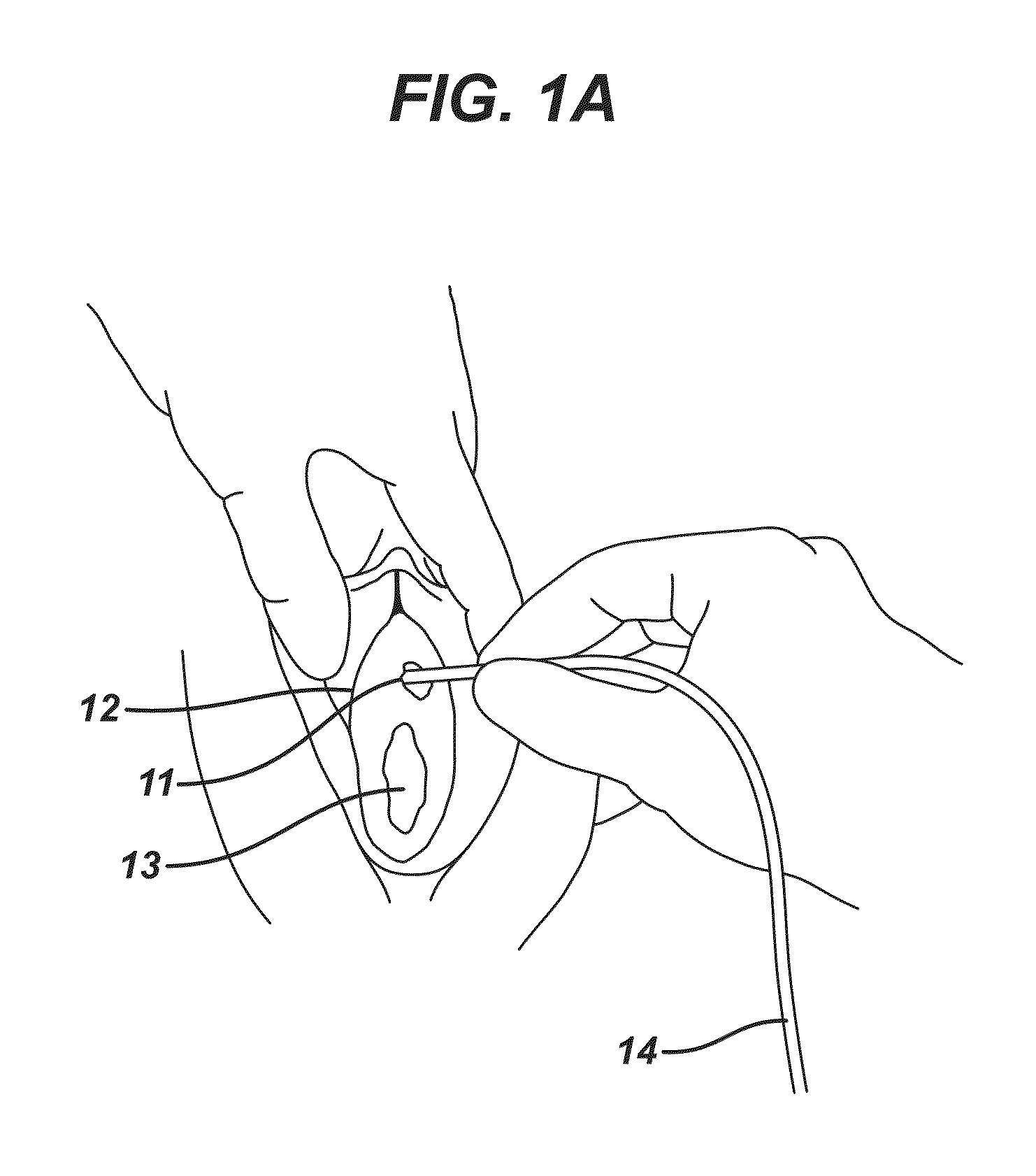 Methods and devices for preventing catheter related urinary tract infections