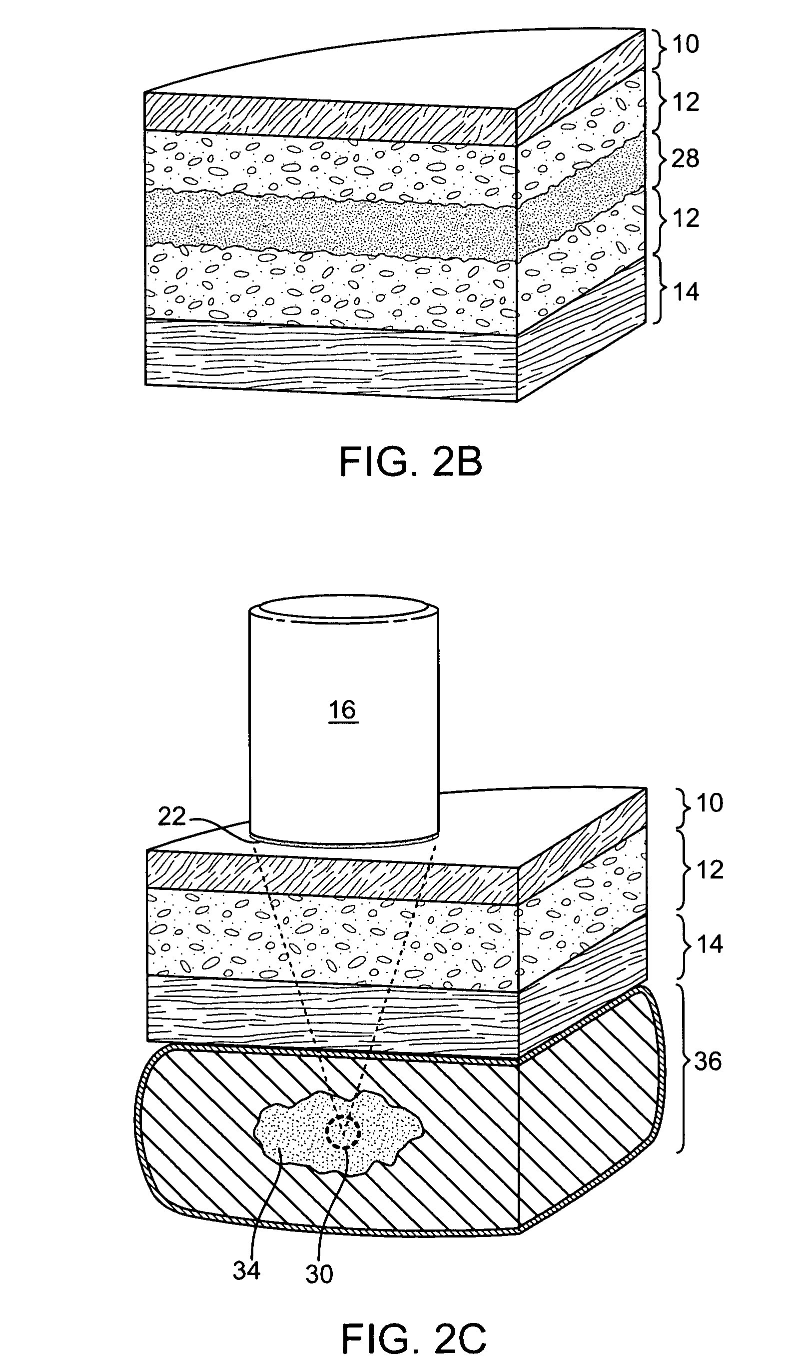 Methods and apparatus for coupling a HIFU transducer to a skin surface