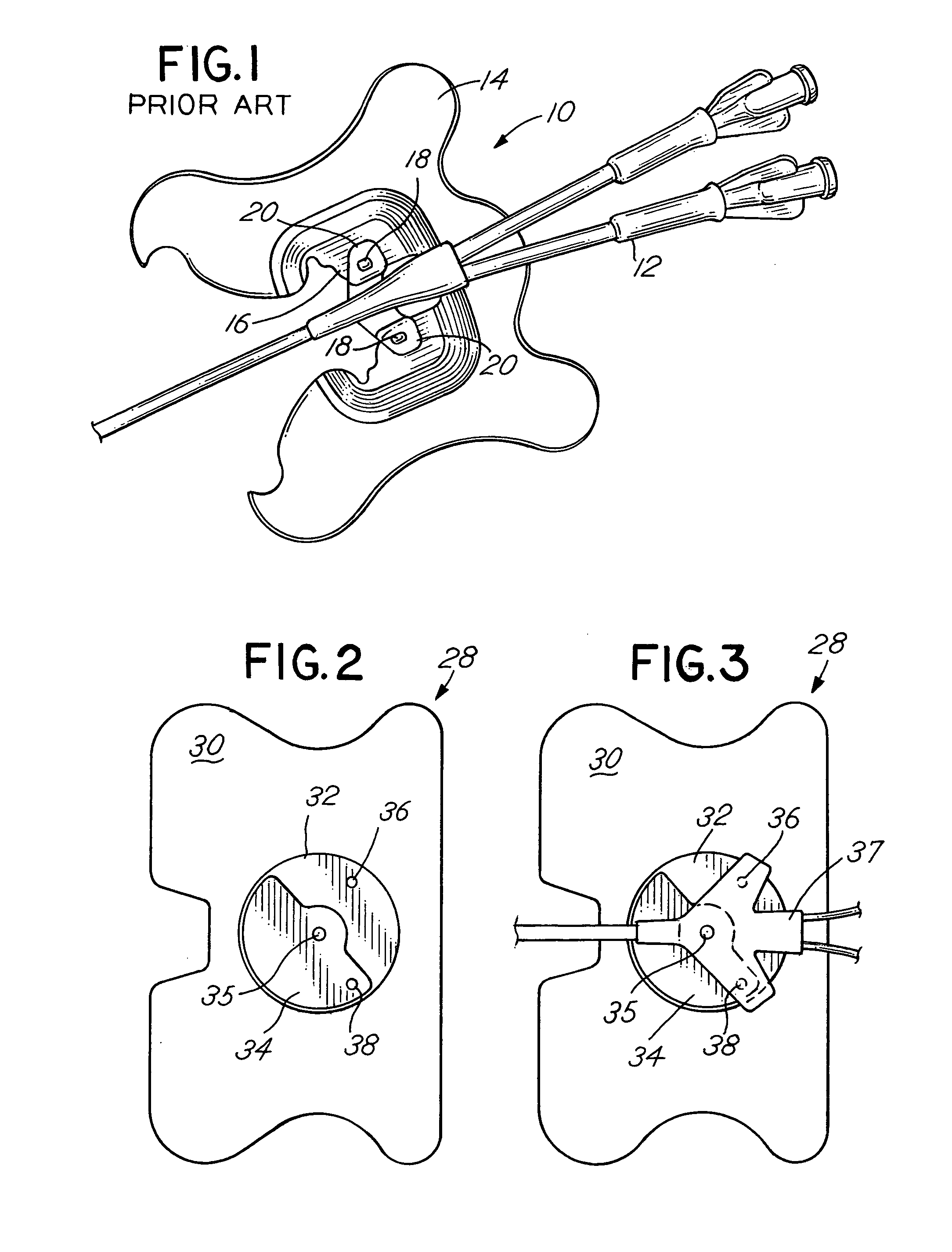 Catheter securement device