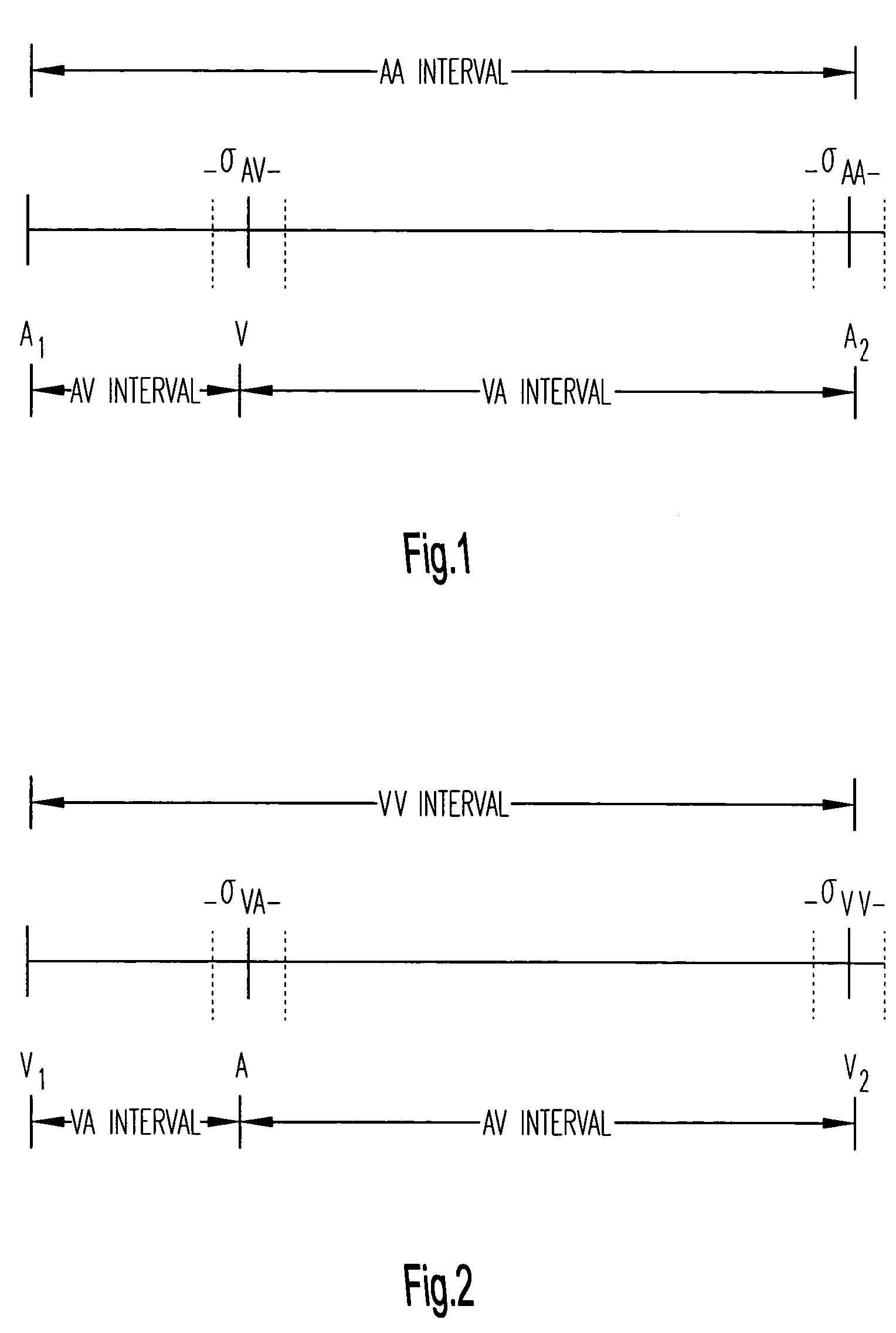 Algorithm for discrimination of 1:1 tachycardias