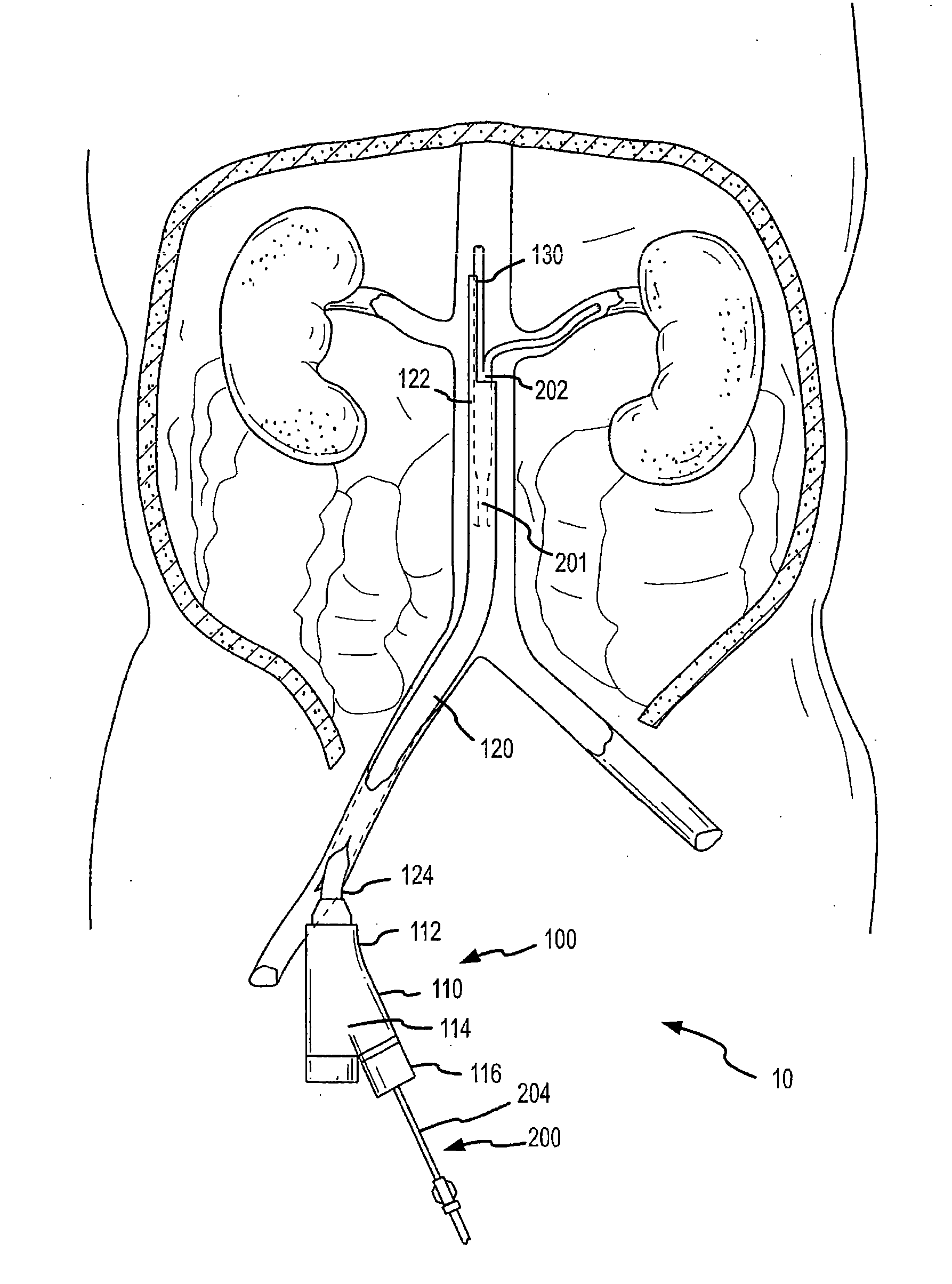 Selective renal cannulation and infusion systems and methods