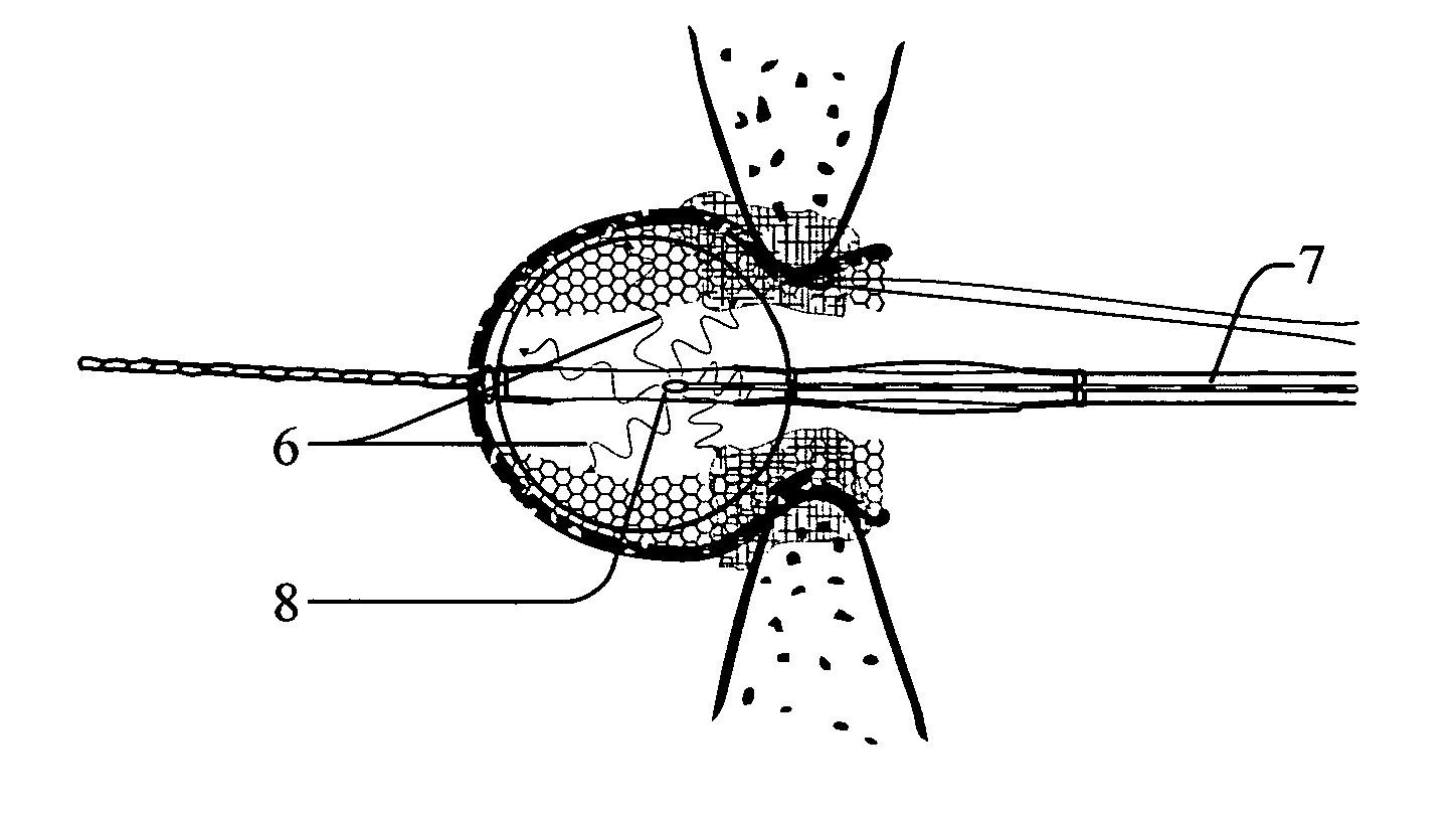 Method and apparatus for occluding a physiological opening