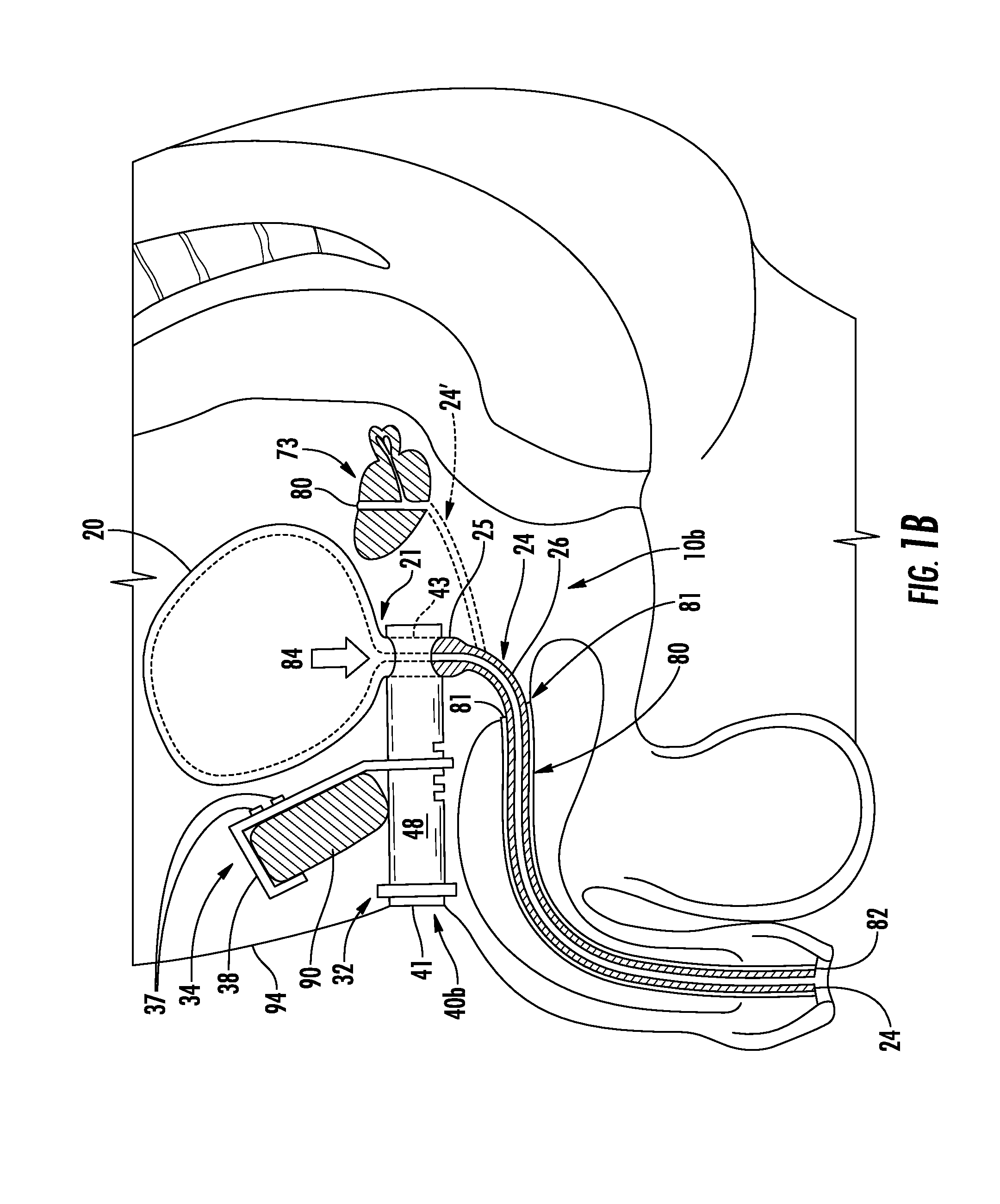 Urinary flow control device and method