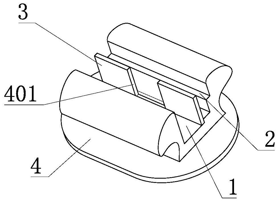 An orthodontic self-ligating bracket system with an open auxiliary groove