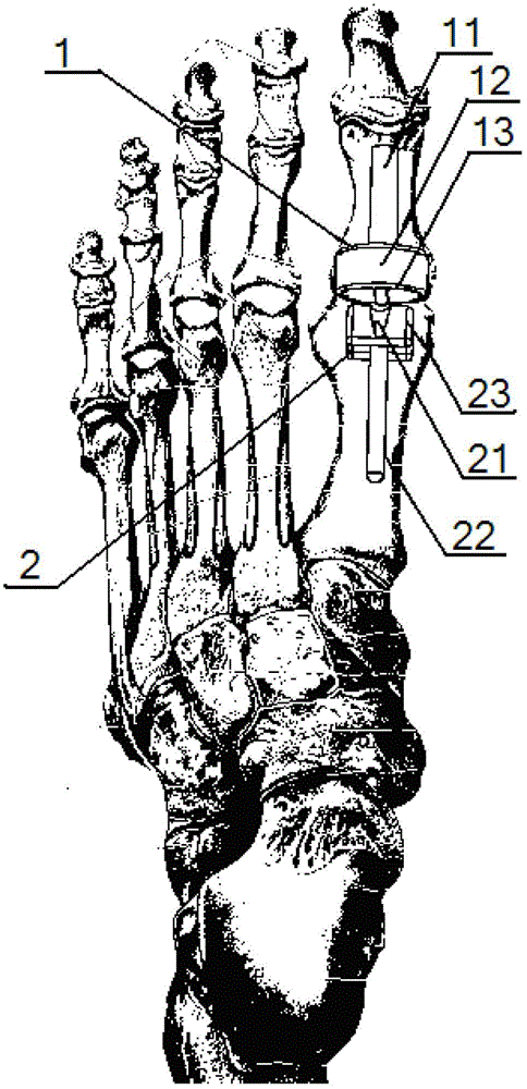 A magnetic joint prosthesis