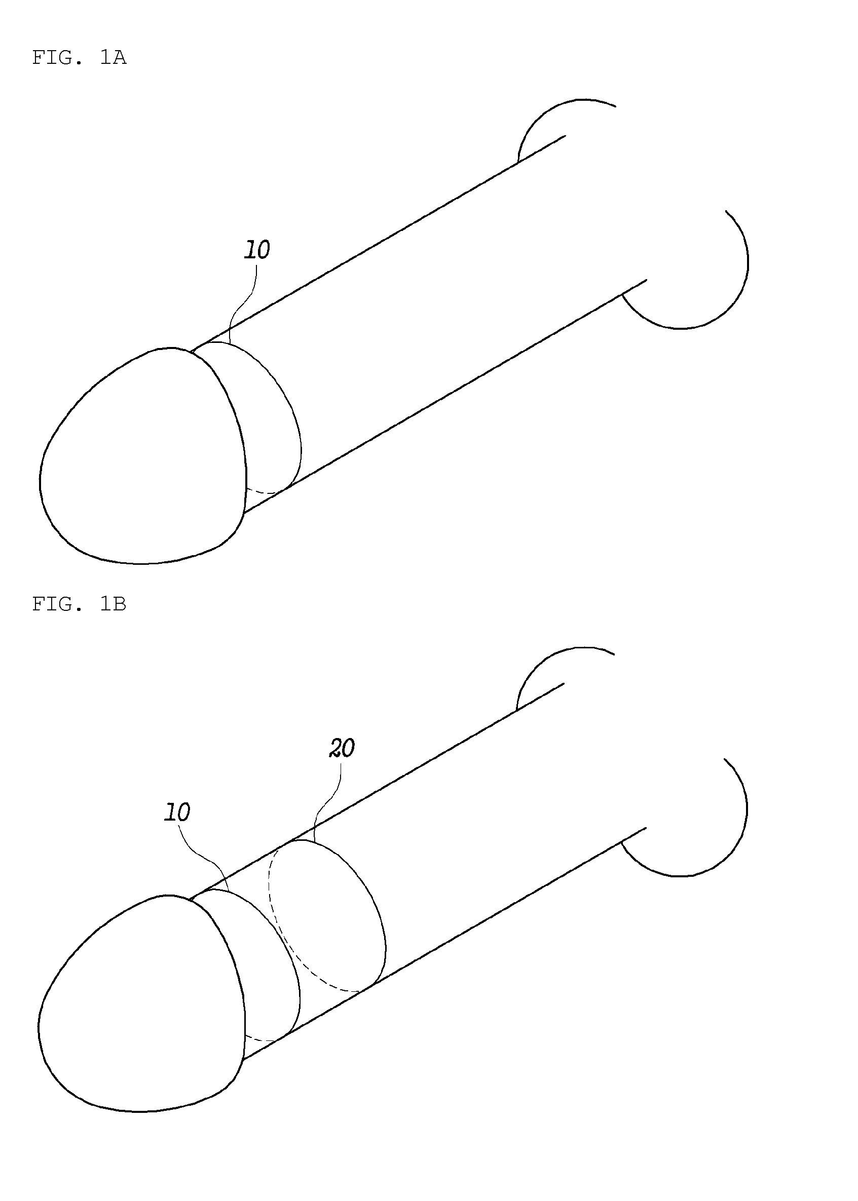 Method for complex phaloplasty using circumcised foreskin as autograft