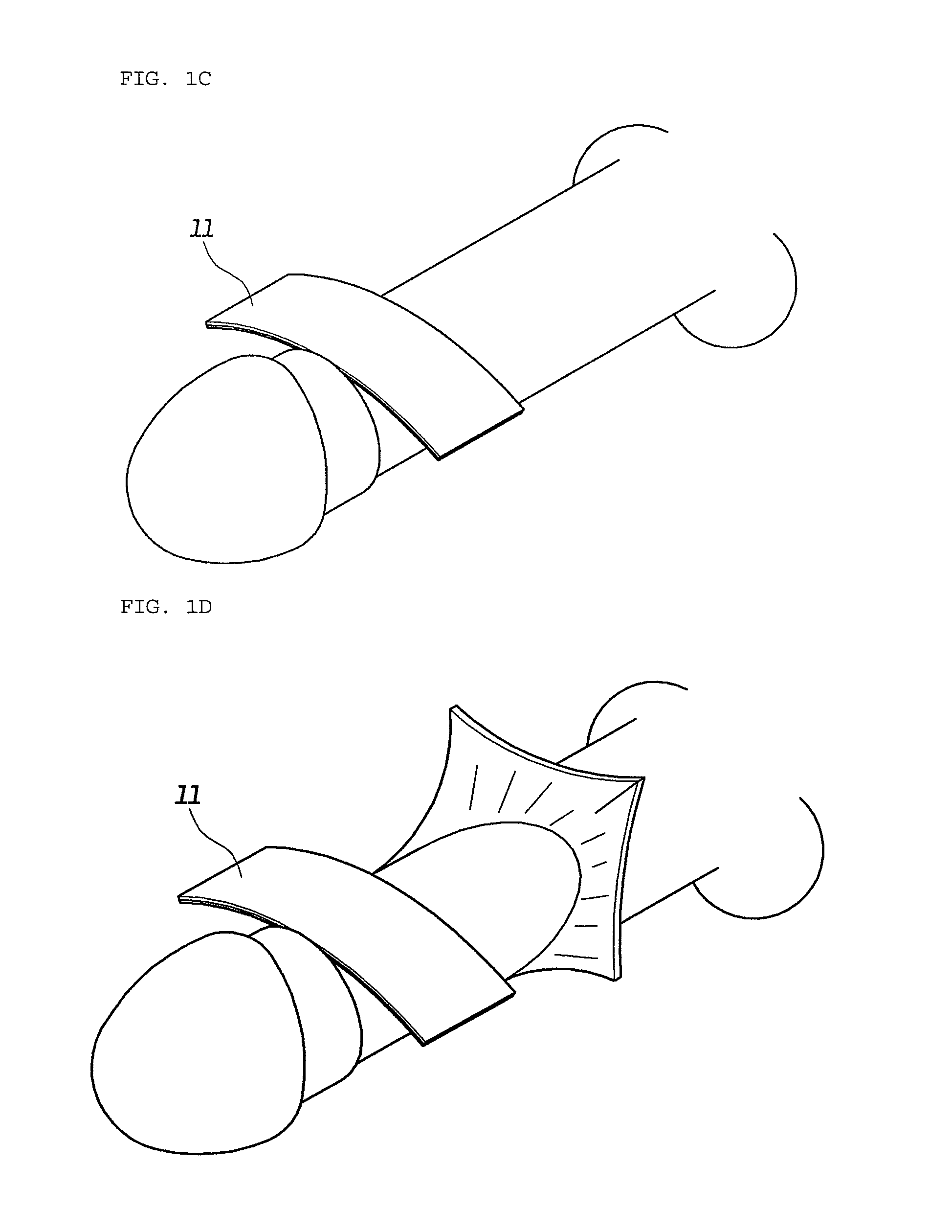 Method for complex phaloplasty using circumcised foreskin as autograft