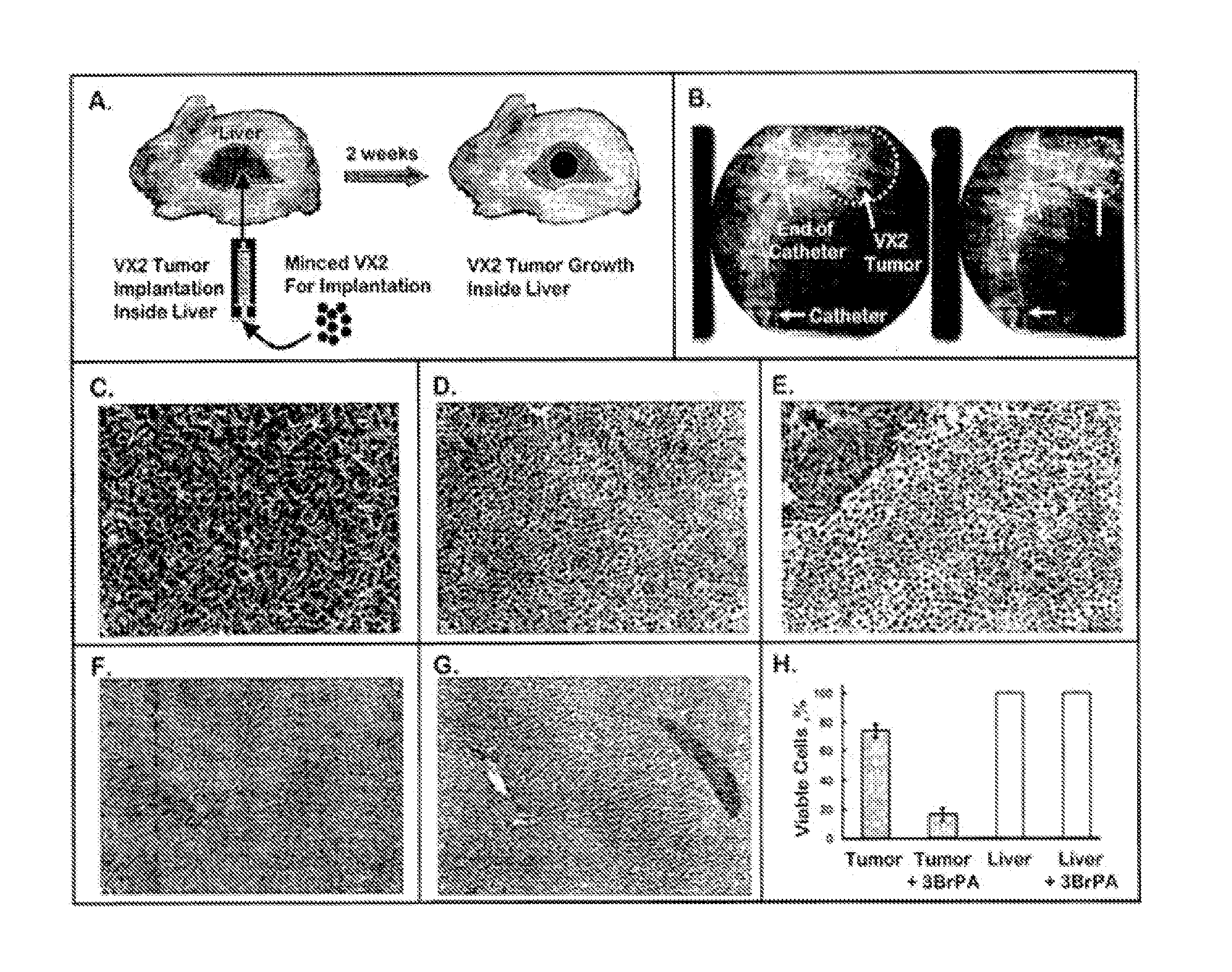 Therapeutics for cancer using 3-bromopyruvate and other selective inhibitors of atp production