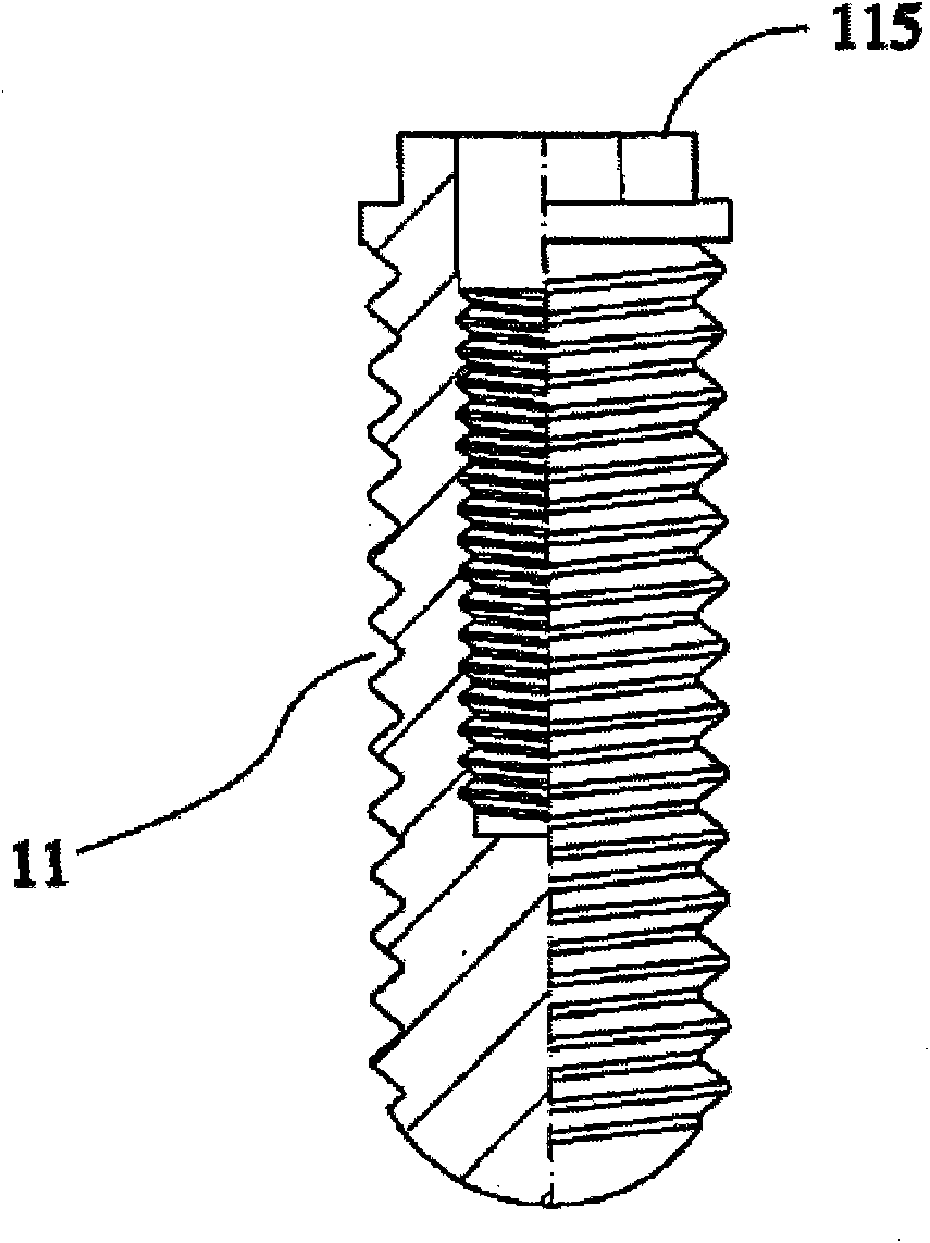 Method for designing implant prosthesis