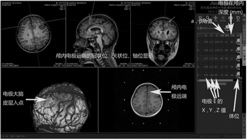 Implementation method for stereotactic electroencephalogram based on Leksell framework