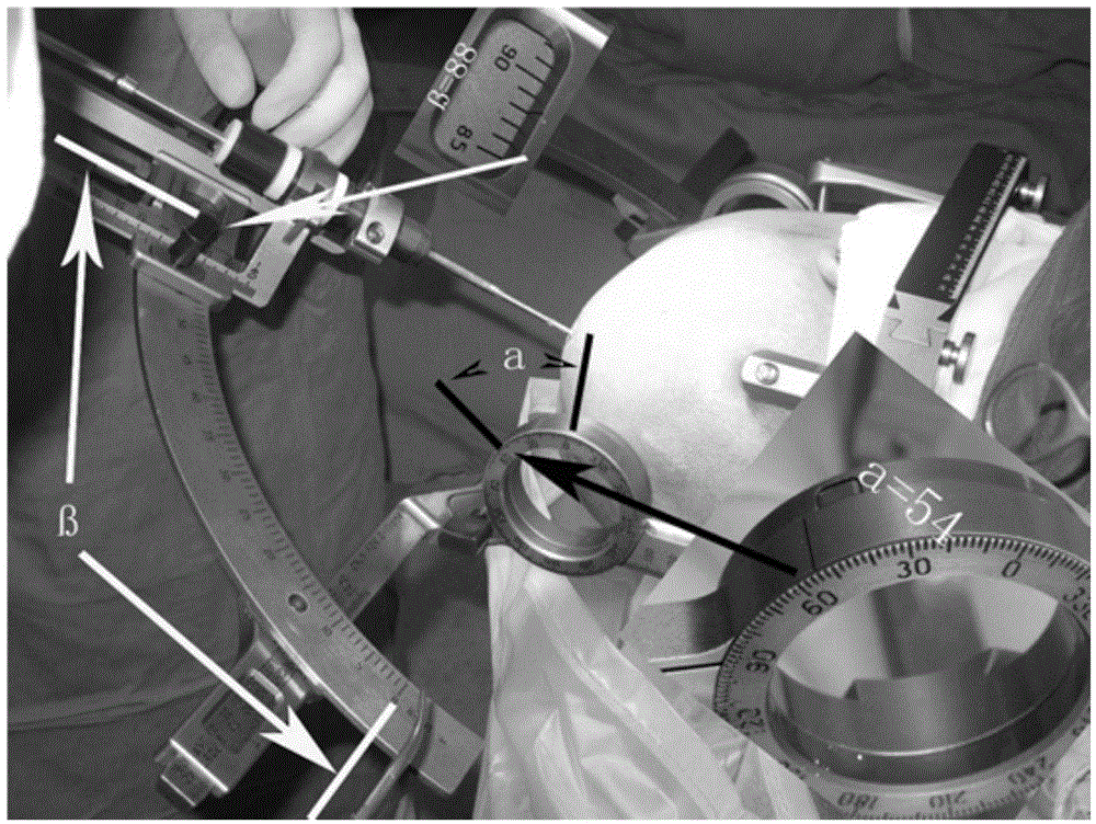 Implementation method for stereotactic electroencephalogram based on Leksell framework