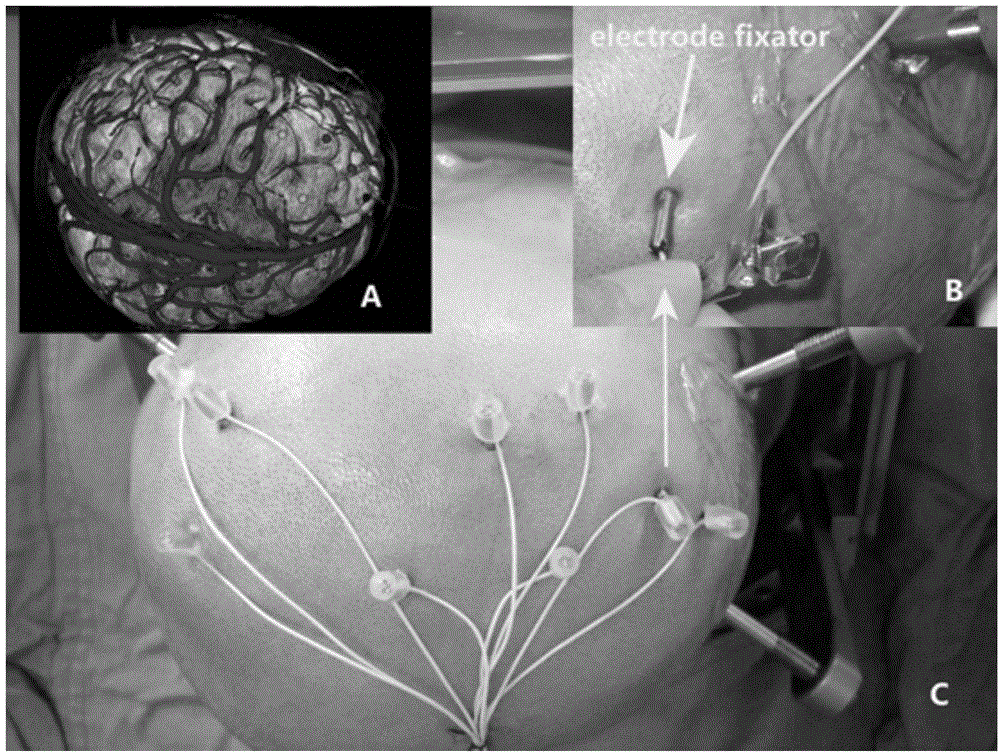 Implementation method for stereotactic electroencephalogram based on Leksell framework