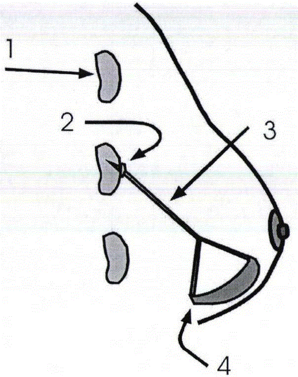 Minimally-invasive breast in-vivo implantation device system and tool combination