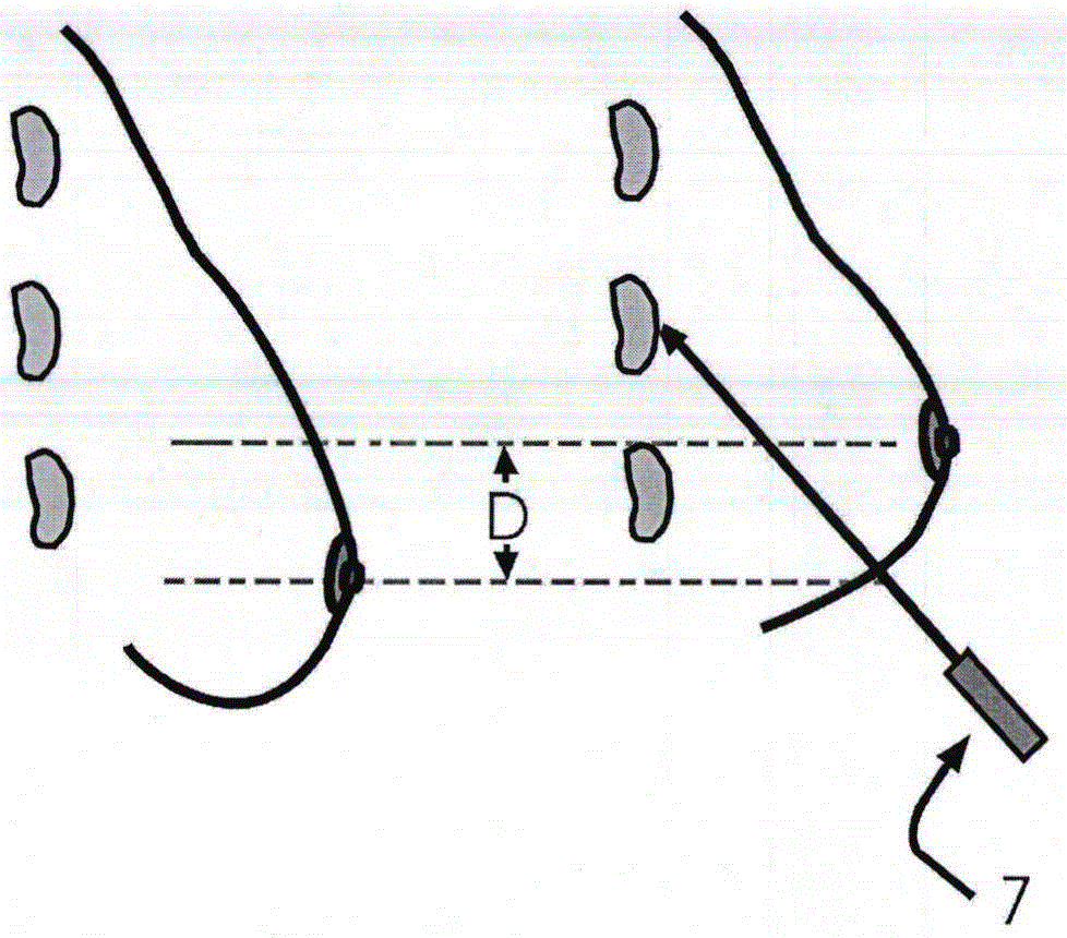 Minimally-invasive breast in-vivo implantation device system and tool combination