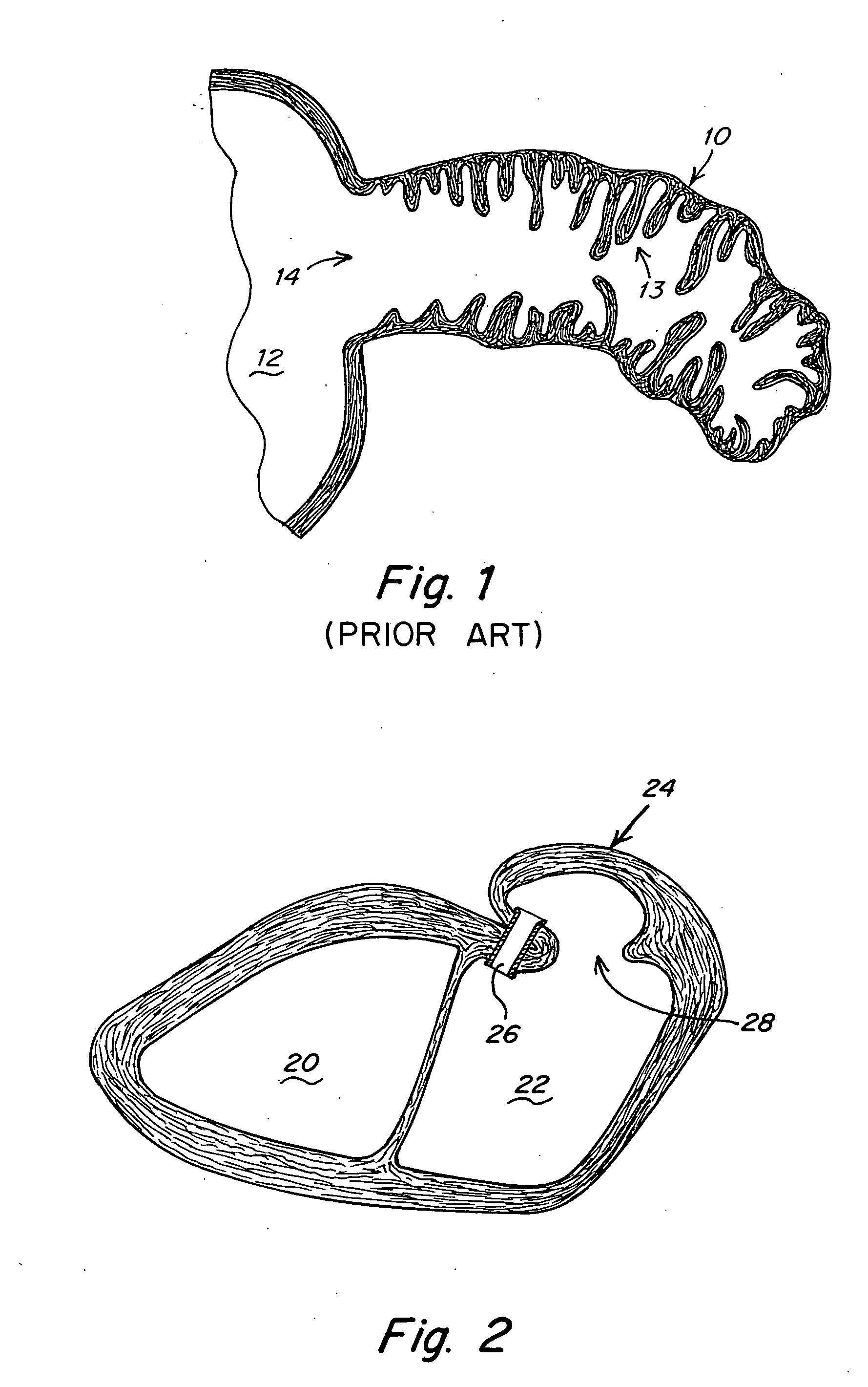 Restoration of flow in LAA via tubular conduit