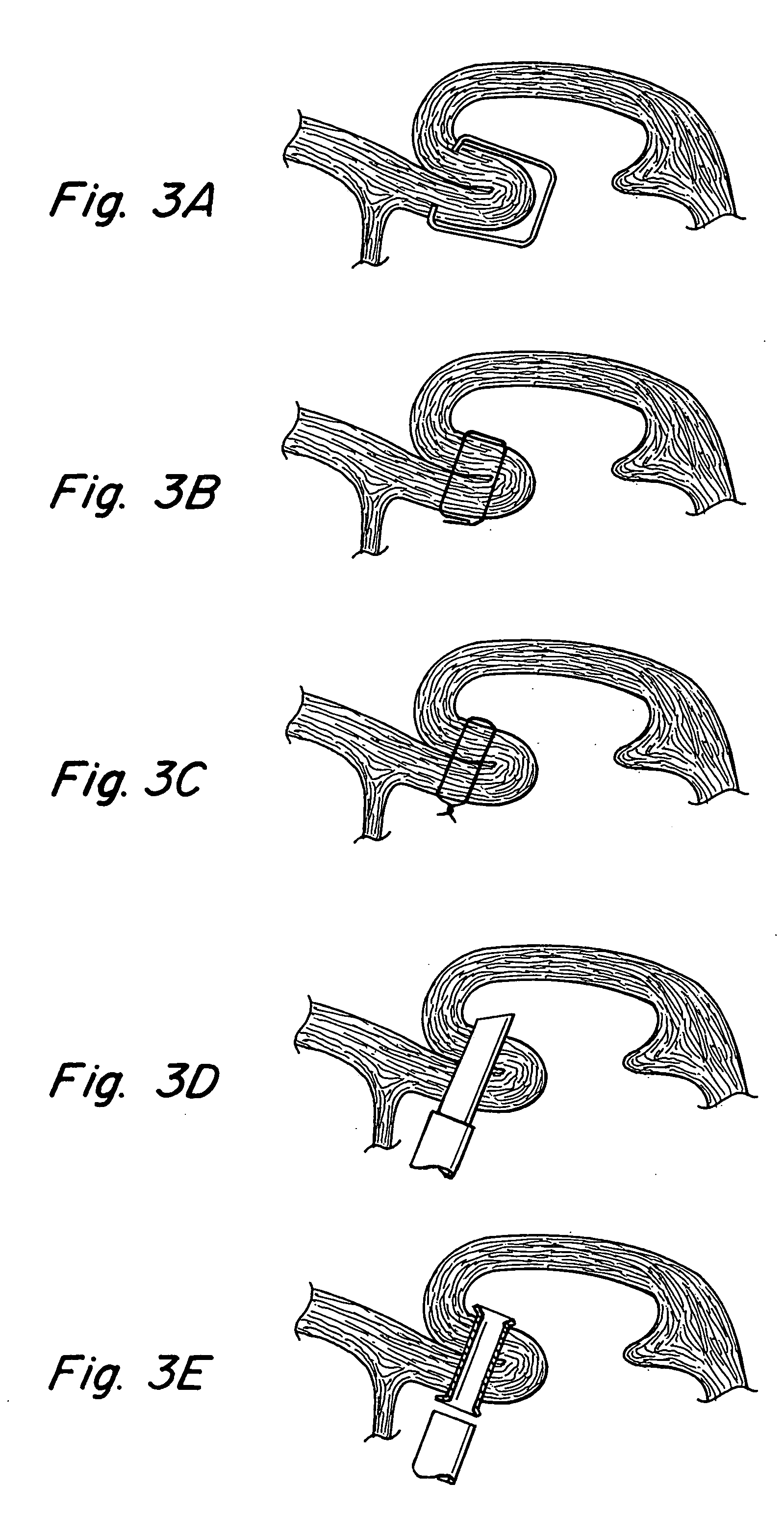 Restoration of flow in LAA via tubular conduit