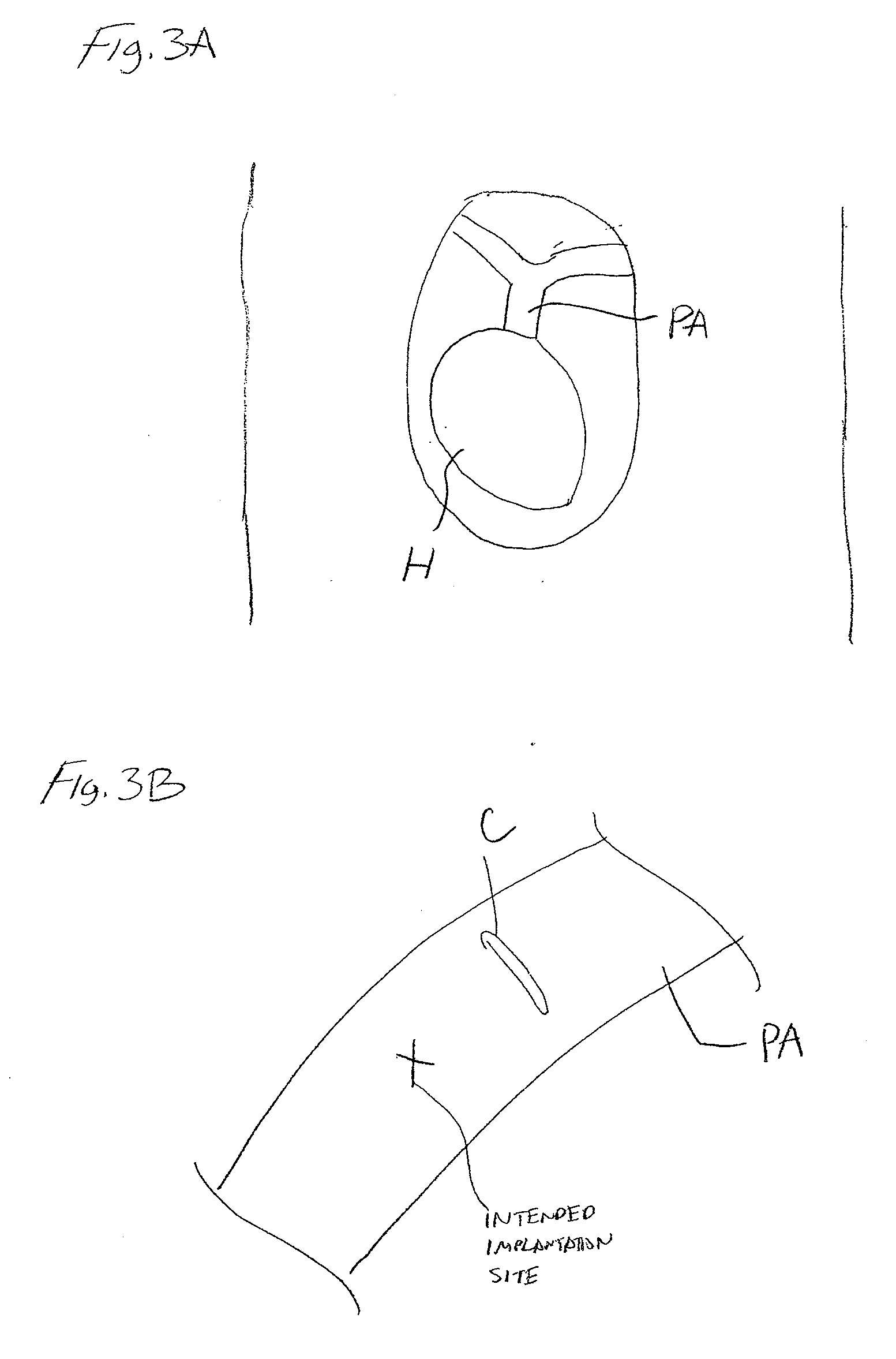 Methods of implanting wireless device within an anatomical cavity during a surgical procedure