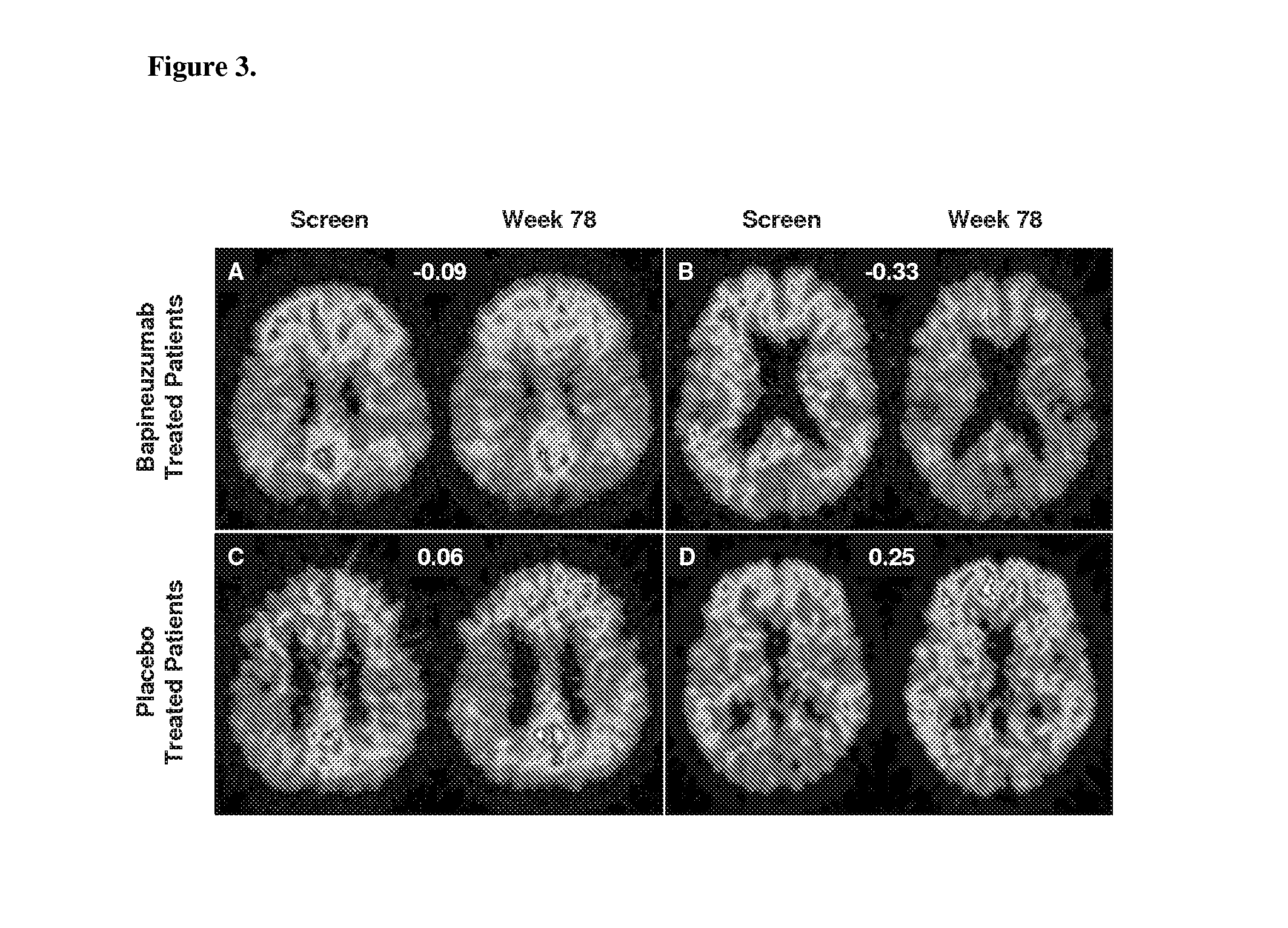 Pet monitoring of a-beta-directed immunotherapy