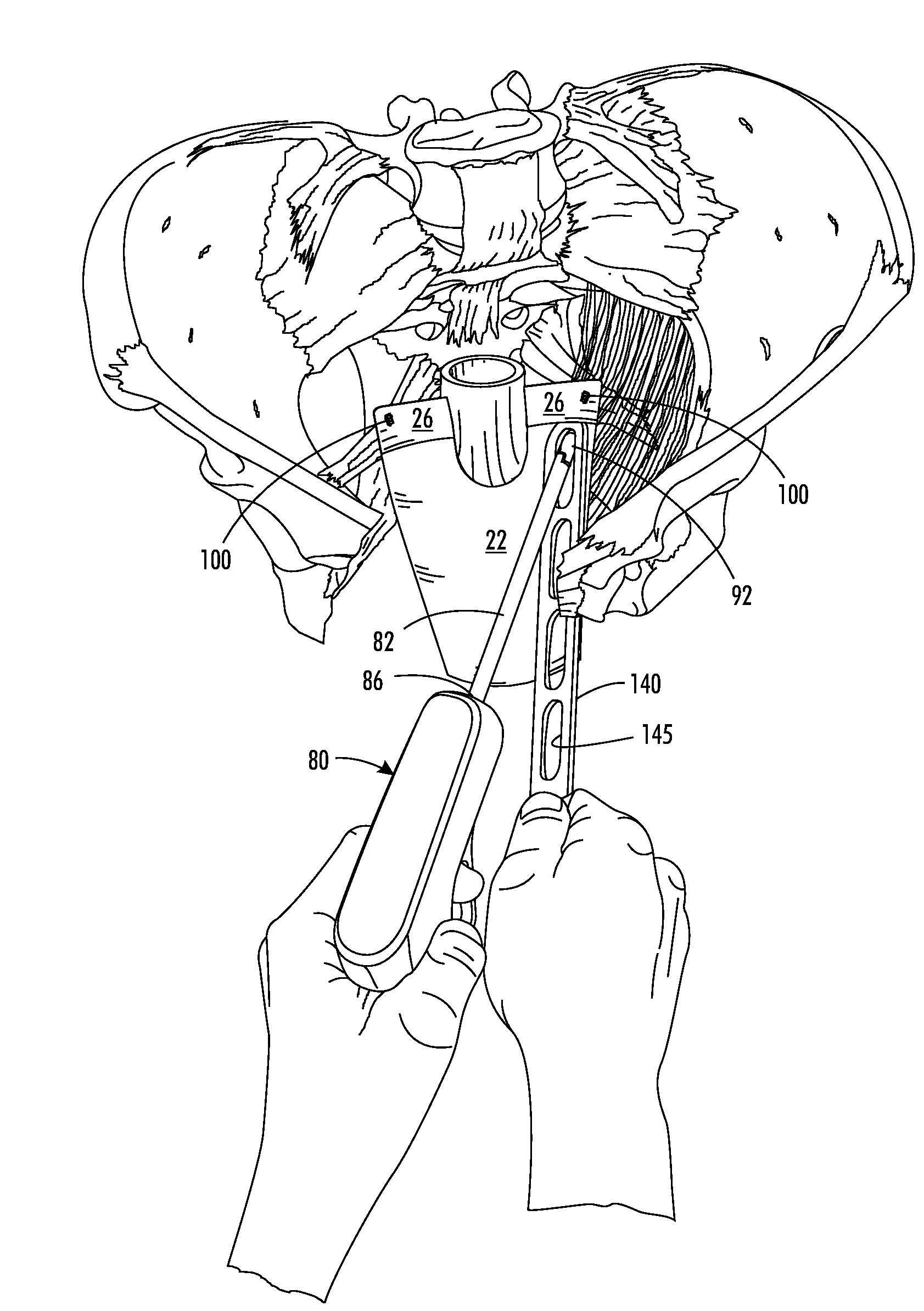 Single-incision minimally-invasive surgical repair of pelvic organ/vaginal prolapse conditions