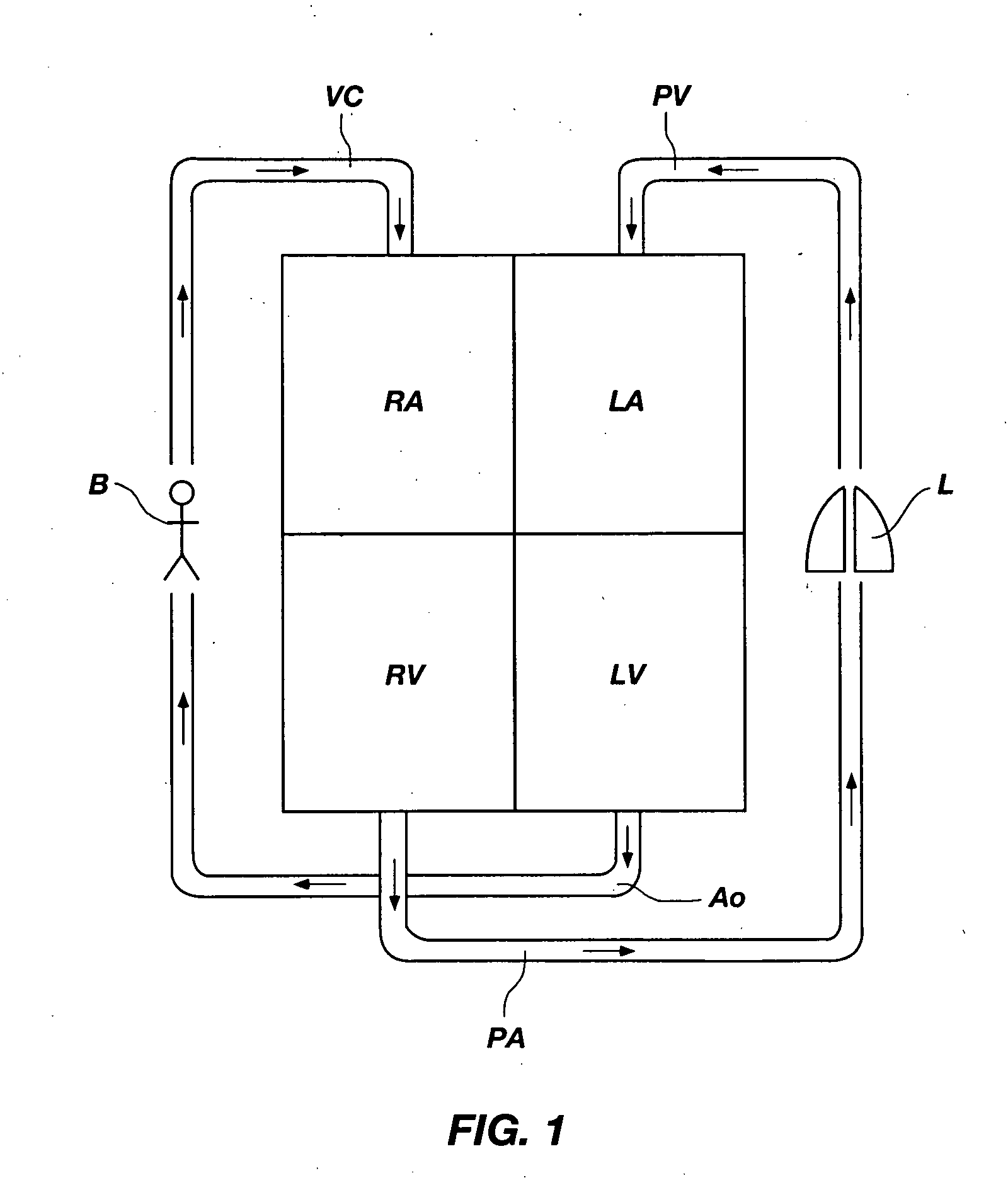 Pulmonary artery banding device