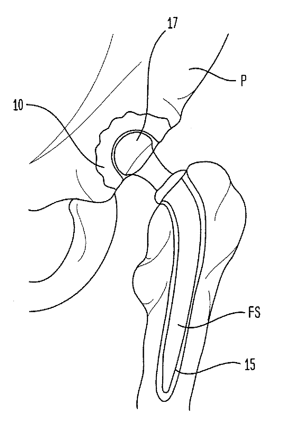 Laser-Produced Porous Surface