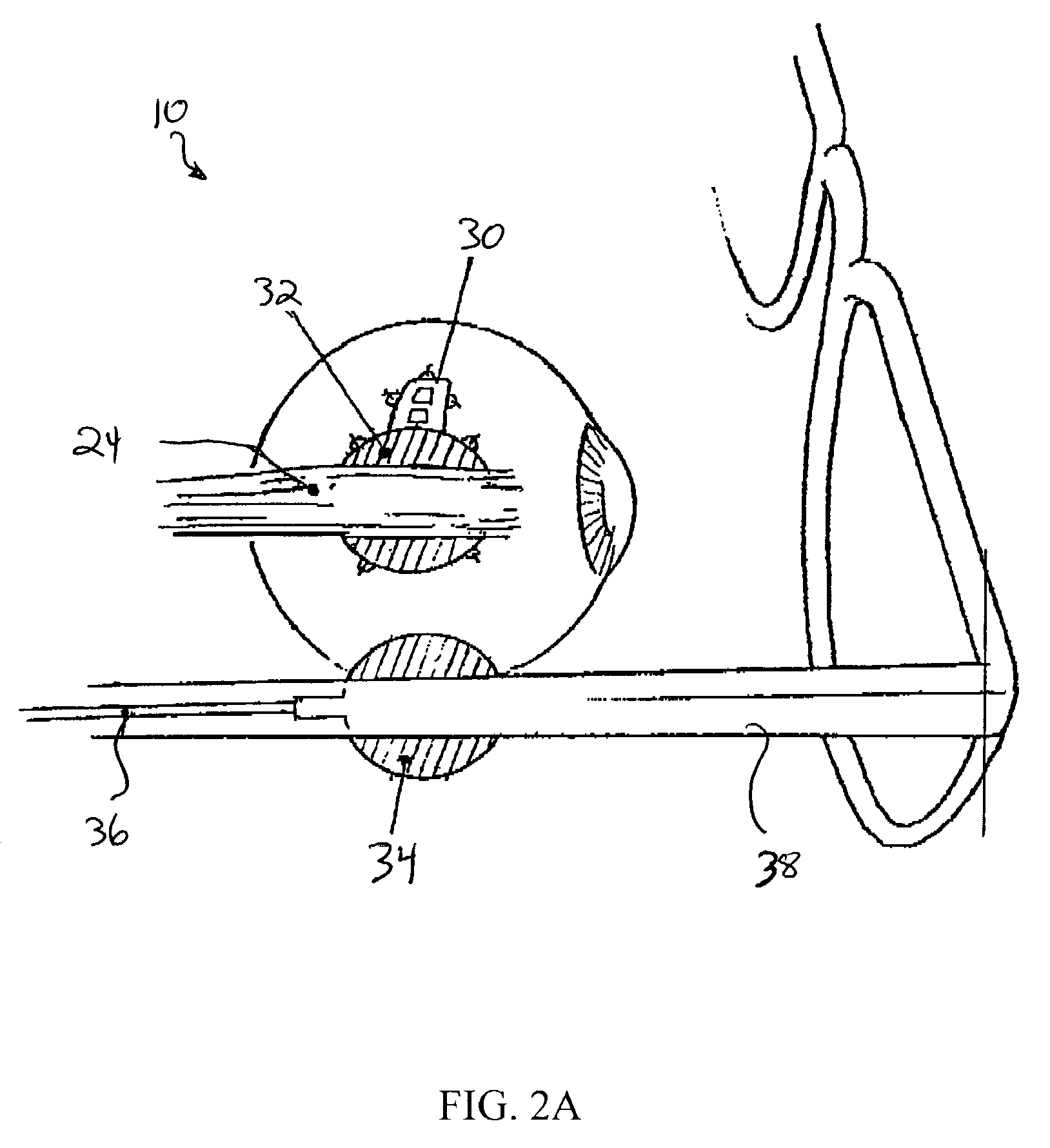 Minimally invasive retinal prosthesis