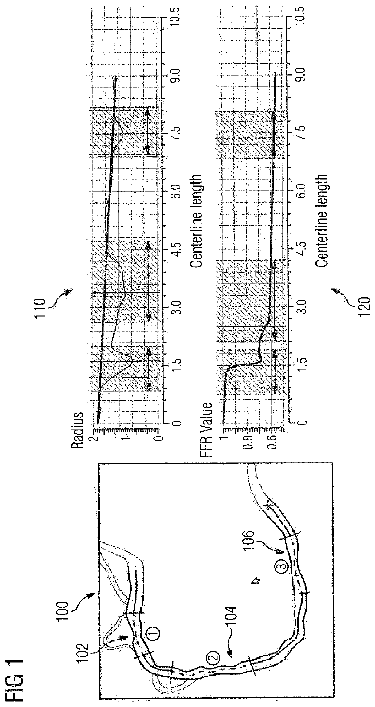 Non-invasive assessment and therapy guidance for coronary artery disease in diffuse and tandem lesions