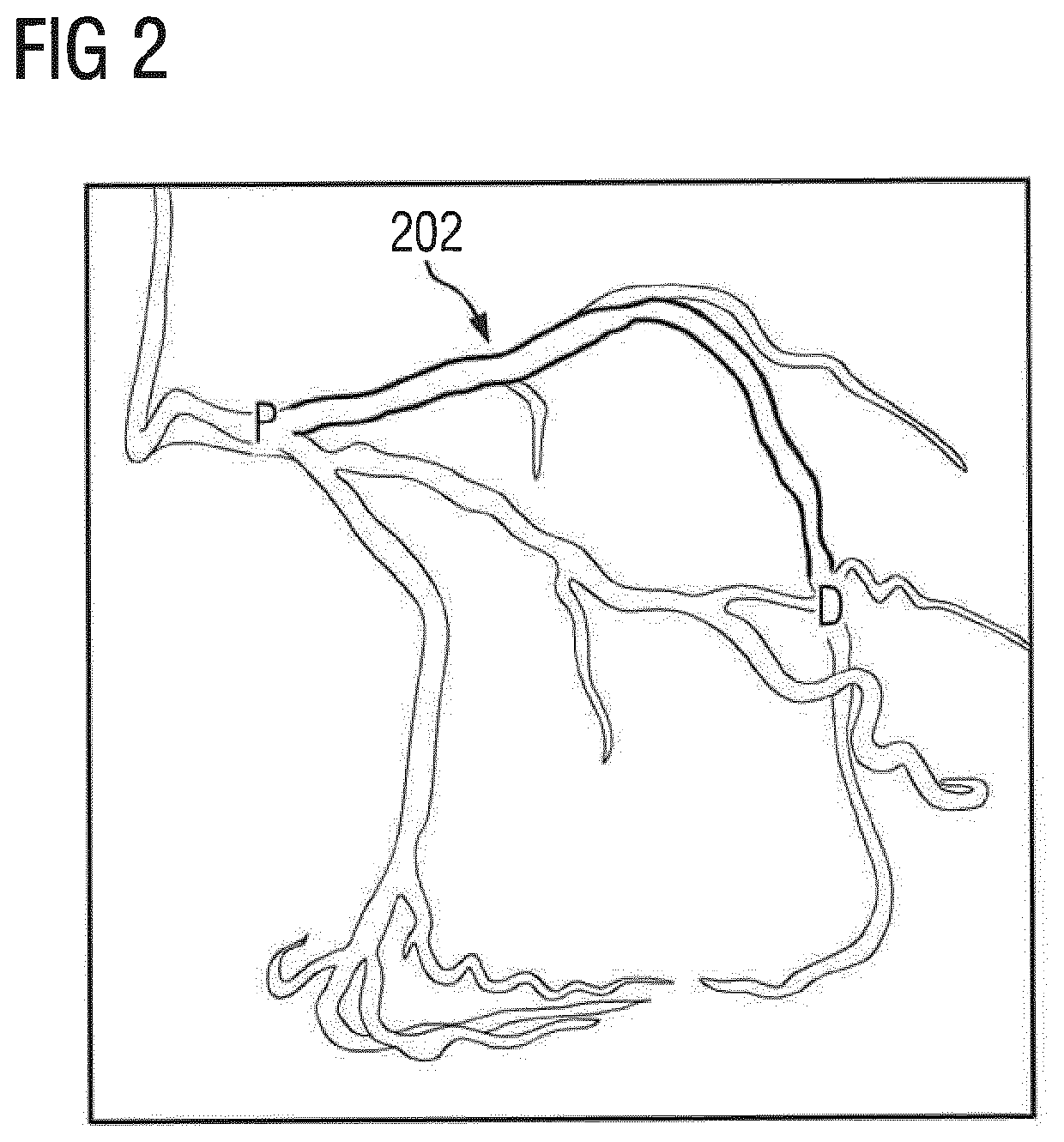 Non-invasive assessment and therapy guidance for coronary artery disease in diffuse and tandem lesions