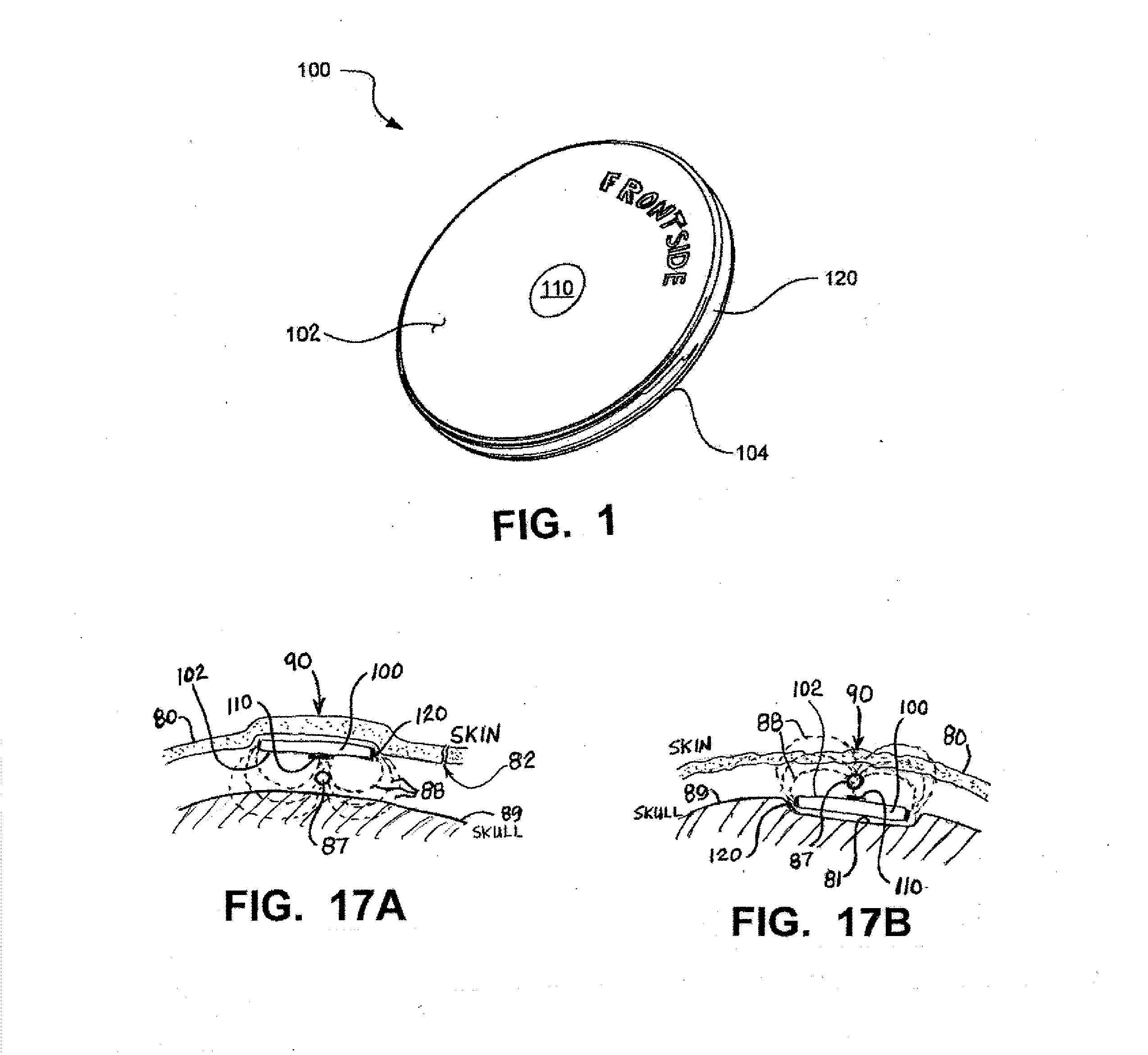 Implantable Electroacupuncture System and Method for Treating Dyslipidemia and Obesity