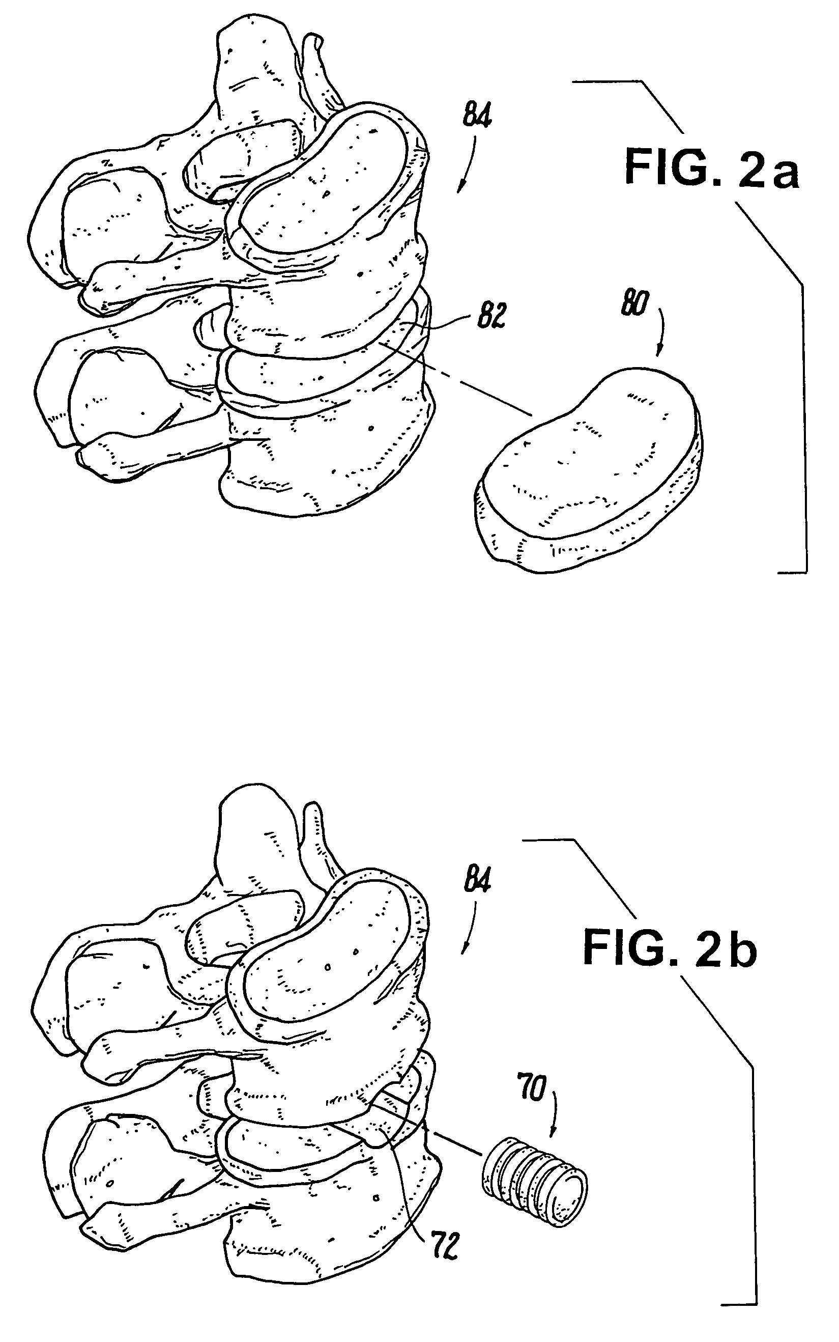 Methods of making shaped load-bearing osteoimplant