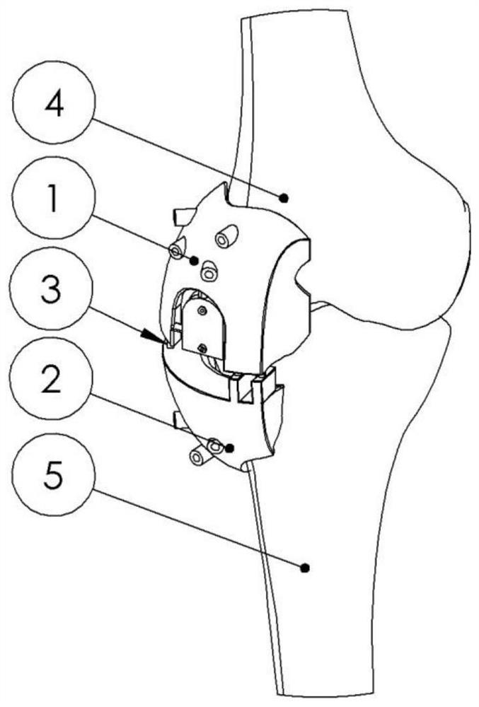 Single condyle replacement guiding template and use method thereof