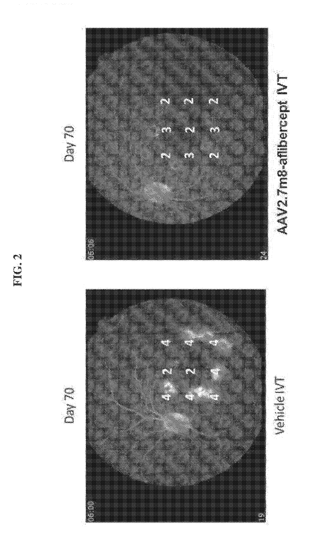 Treatment of AMD using aav2 variant with aflibercept