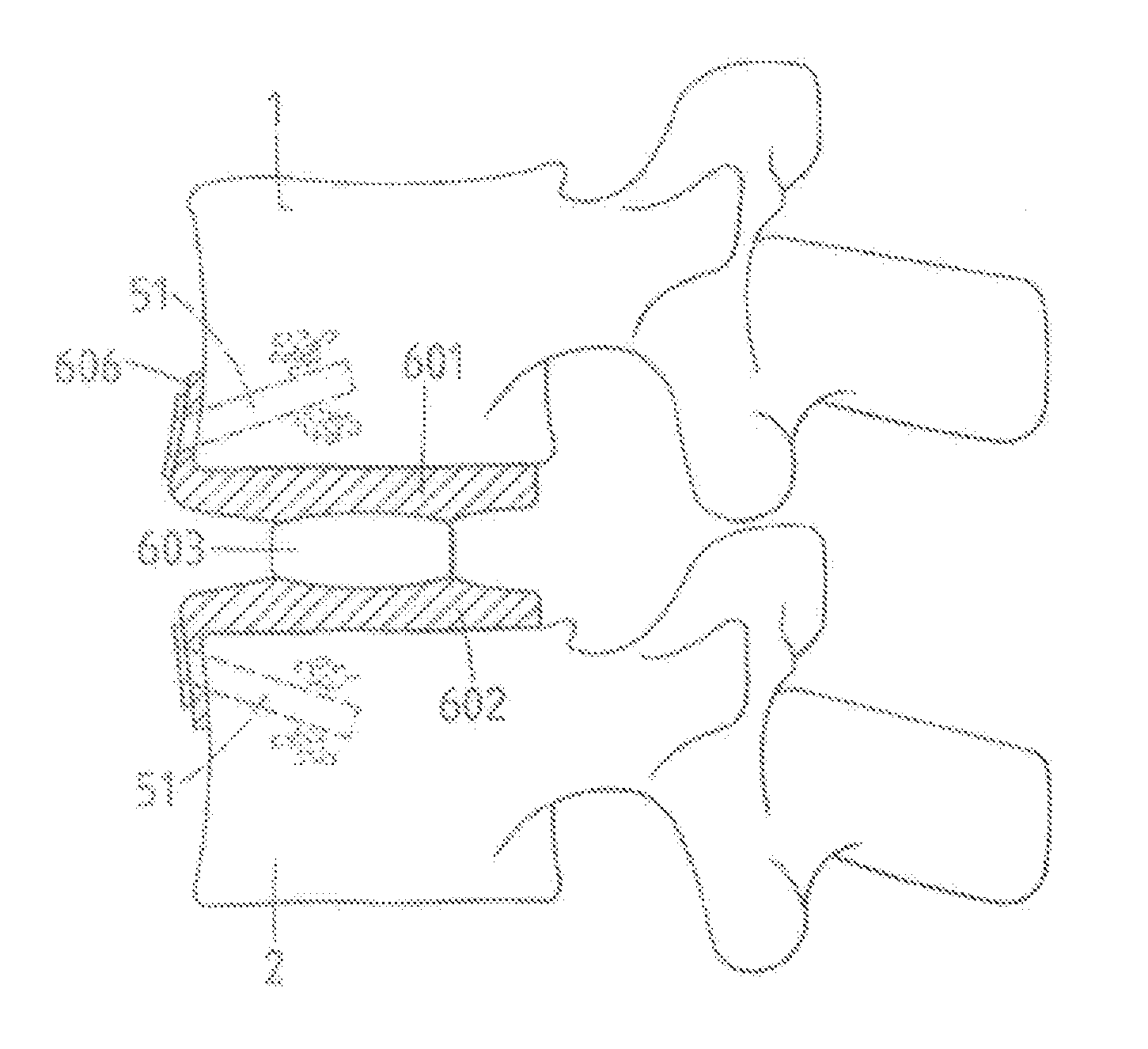 Spine stabilization device, and method and kit for its implantation