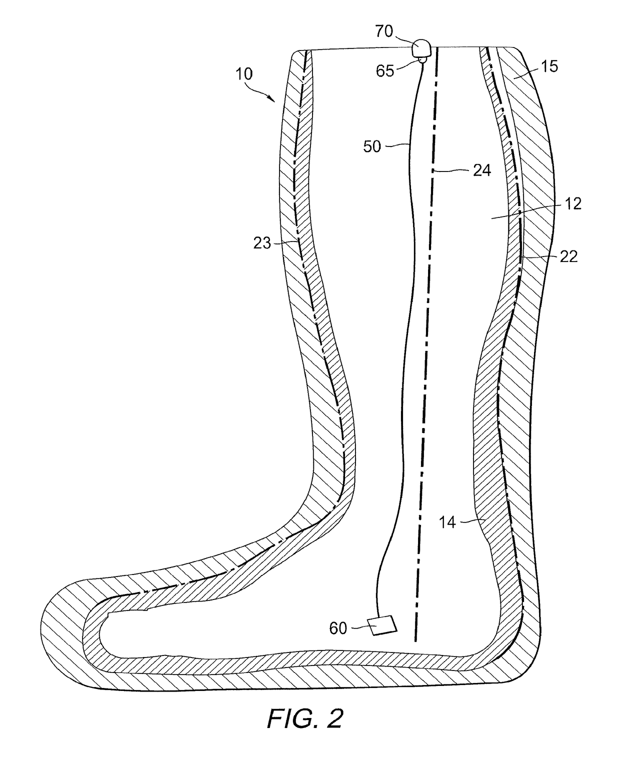 Total contact cast system and methods for safe and easy removal thereof