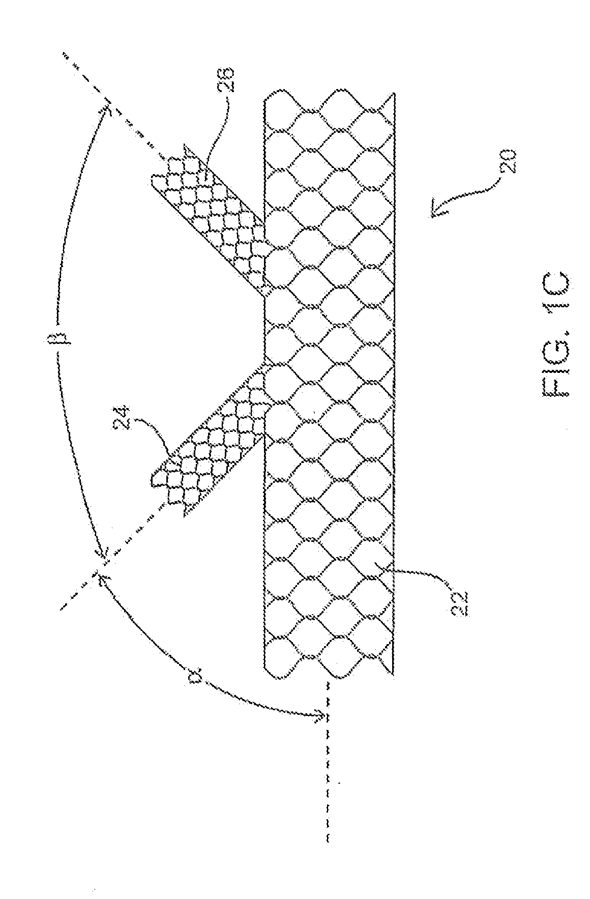 Apparatus and method for deploying an implantable device within the body