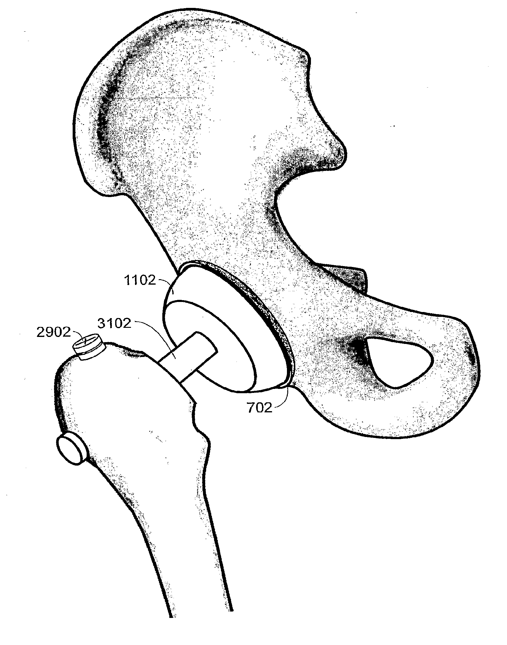 Methods and systems for total hip replacement