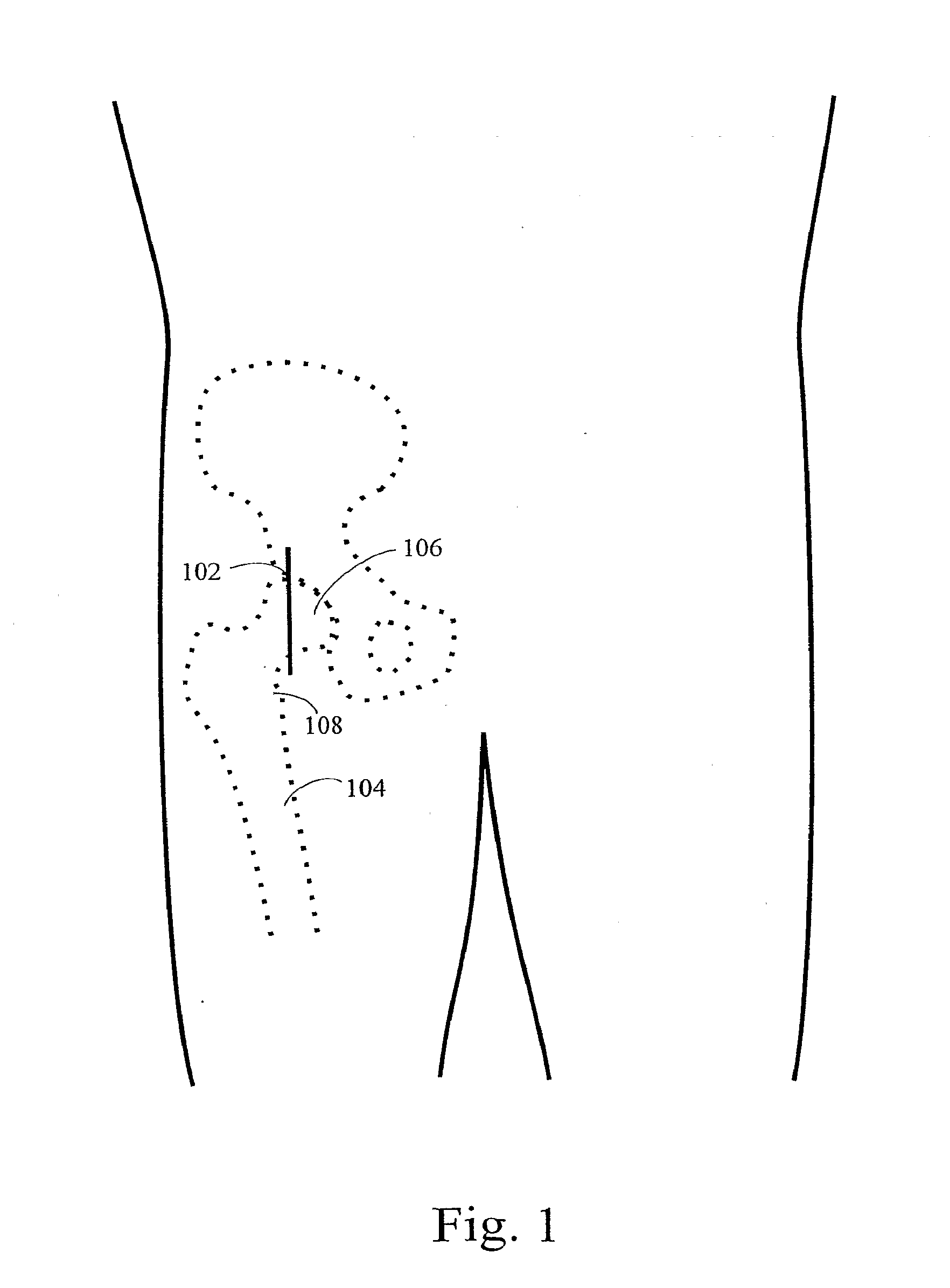 Methods and systems for total hip replacement