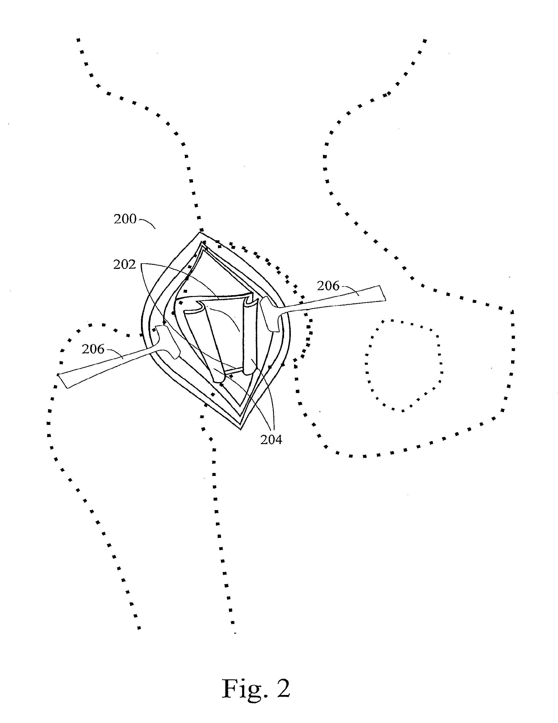 Methods and systems for total hip replacement