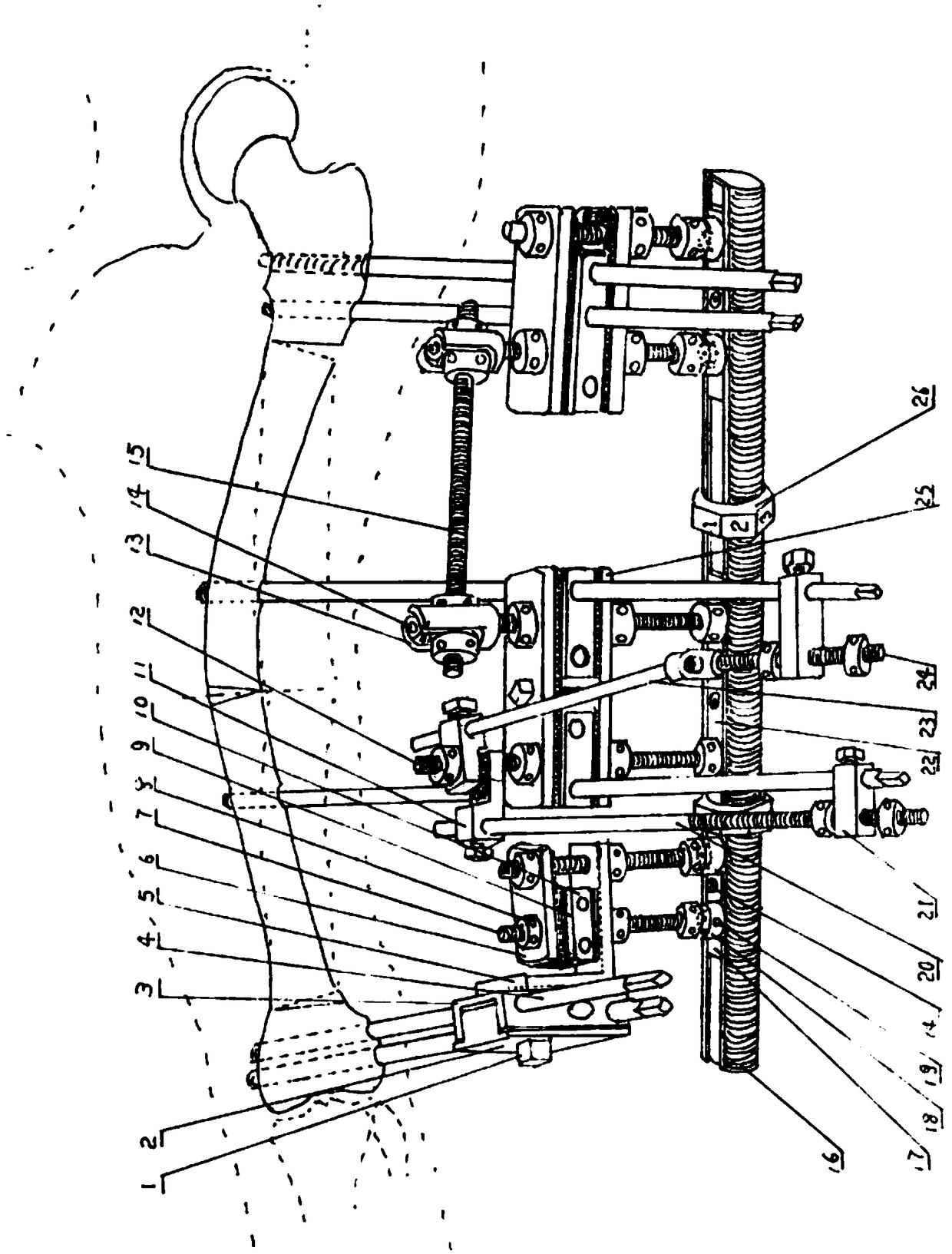 Mechanical double-upper-limb dynamic comprehensive restitution multi-section bone malformation external fixing support